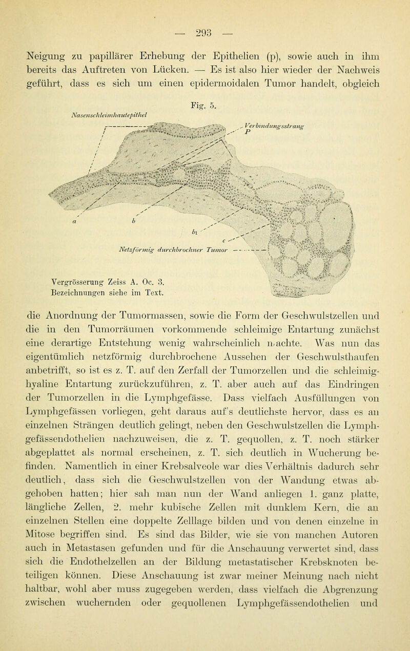 Neigung zu papillärer Erhebung der Epithelien (p), sowie auch in ihm bereits das Auftreten von Lücken. — Es ist also hier wieder der Nachweis geführt, dass es sich um einen epidermoidalen Tumor handelt, obgleich Fig. 5. Nasenschleimhauiepühel . Verbindungsstrang Netzförmig durchbrochner Tumor ; ^'^ ; Vergrösserung Zeiss A. Oc. 3. ;, . Bezeichnungen siehe im Text. • ^^^i^:..-—^ die Anordnung der Tumormassen, sowie die Form der Geschwulstzellen und die in den Tumorräumen vorkommende schleimige Entartung zunächst eine derartige Entstehung wenig wahrscheinlich machte. Was nun das eigentümlich netzförmig durchbrochene Aussehen der Geschwulsthaufen anbetrifft, so ist es z. T. auf den Zerfall der Tumorzellen und die schleimig- hyaline Entartung zurückzuführen, z. T. aber auch auf das Eindringen der Tumorzellen in die Lymphgefässe. Dass vielfach Ausfüllungen von Ljmphgefässen vorliegen, geht daraus auf's deutlichste hervor, dass es an einzelnen Strängen deutlich gelingt, neben den Geschwulstzellen die Lymph- gefässendothelien nachzuweisen, die z. T. gequollen, z. T. noch stärker abgeplattet als normal erscheinen, z. T. sich deutlich in Wucherung be- finden. Namentlich in einer Krebsalveole war dies Verhältnis dadurch sehr deutlich, dass sich die Geschwulstzellen von der Wandung etwas ab- gehoben hatten; hier sah man nun der Wand anliegen 1. ganz platte, längliche Zellen, 2. mehr kubische Zellen mit dunklem Kern, die an einzelnen Stellen eine doppelte Zelllage bilden und von denen einzelne in Mitose begriffen sind. Es sind das Bilder, wie sie von manchen Autoren auch in Metastasen gefunden und für die Anschauung verwertet sind, dass sich die Endothelzellen an der Bildung metastatischer Krebsknoten be- teiligen können. Diese Anschauung ist zwar meiner Meinung nach nicht haltbar, wohl aber muss zugegeben werden, dass vielfach die Abgrenzung zwischen wuchernden oder gequollenen Lymphgefässendothelien und