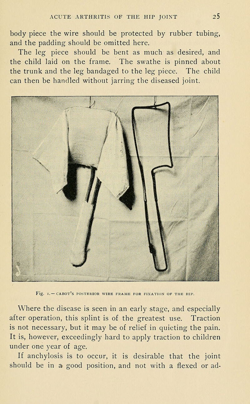 body piece the wire should be protected by rubber tubing, and the padding should be omitted here. The leg piece should be bent as much as desired, and the child laid on the frame. The swathe is pinned about the trunk and the leg bandaged to the leg piece. The child can then be handled without jarring the diseased joint. Fig. I.— cabot's posterior wire frame for fixation of the hip. Where the disease is seen in an early stage, and especially after operation, this splint is of the greatest use. Traction is not necessary, but it may be of relief in quieting the pain. It is, however, exceedingly hard to apply traction to children under one year of age. If anchylosis is to occur, it is desirable that the joint should be in a good position, and not with a flexed or ad-