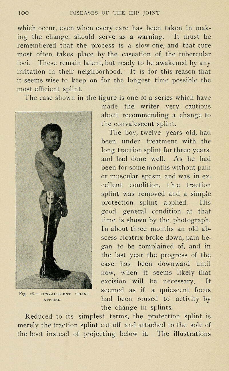 which occur, even when every care has been taken in mak- ing the change, should serve as a warning. It must be remembered that the process is a slow one, and that cure most often takes place by the caseation of the tubercular foci. These remain latent, but ready to be awakened by any irritation in their neighborhood. It is for this reason that it seems wise to keep on for the longest time possible the most efficient splint. The case shown in the figure is one of a series which have made the writer very cautious about recommending a change to the convalescent splint. The boy, twelve years old, had been under treatment with the long traction splint for three years, and had done well. As he had been for some months without pain or muscular spasm and was in ex- cellent condition, the traction splint was removed and a simple protection splint applied. His good general condition at that time is shown by the photograph. In about three months an old ab- scess cicatrix broke down, pain be- gan to be complained of, and in the last year the progress of the case has been downward until now, when it seems likely that excision will be necessary. It seemed as if a quiescent focus had been roused to activity by the change in splints. Reduced to its simplest terms, the protection splint is merely the traction splint cut off and attached to the sole of the boot instead of projecting below it. The illustrations Fig. 28.— CONVALESCENT SPLINT APPLIED.