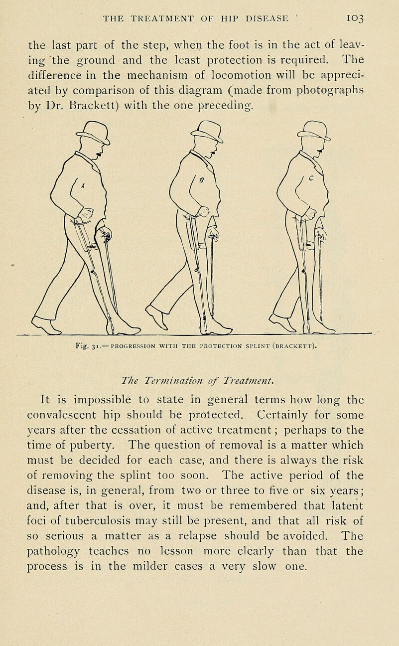 the last part of the step, when the foot is in the act of leav- ing the ground and the least protection is required. The difference in the mechanism of locomotion will be appreci- ated by comparison of this diagram (made from photographs by Dr. Brackett) with the one preceding. Fig. 31.— PROGRESSION WITH THE PROTECTION SPLINT (brACKETT). The Termination of Treatment. It is impossible to state in general terms how long the convalescent hip should be protected. Certainly for some years after the cessation of active treatment; perhaps to the time of puberty. The question of removal is a matter which must be decided for each case, and there is always the risk of removing the splint too soon. The active period of the disease is, in general, from two or three to five or six years; and, after that is over, it must be remembered that latent foci of tuberculosis may still be present, and that all risk of so serious a matter as a relapse should be avoided. The pathology teaches no lesson more clearly than that the process is in the milder cases a very slow one.