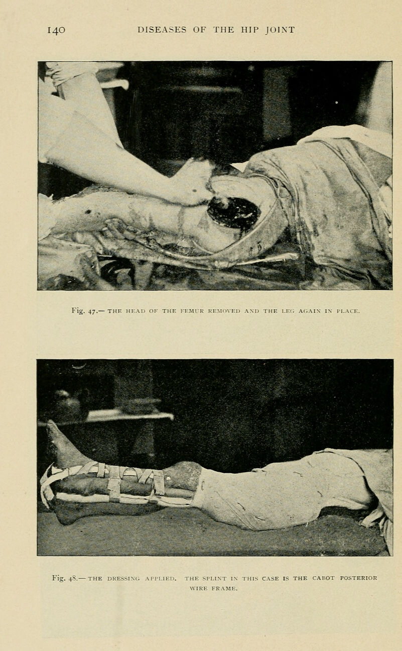 Fig. 47.— THE HEAD OF THE FE.MIR REMOVED AND THE I.Ei; AI.AIN IN ILACE. Fig. 4.S.— THE DRESSING AriLIED. THE SPLINT IN THIS CASE IS THE CACOT POSTERIOR WIRE FRAME.