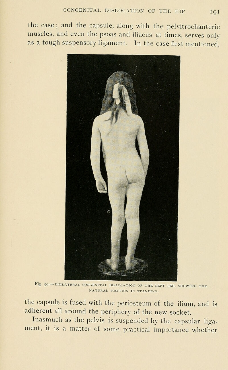 the case; and the capsule, along with the pelvitrochanteric muscles, and even the psoas and iliacus at, times, serves only as a tough suspensory ligament. In the case first mentioned. Fig. 50.—UNILATERAL CONGENITAL DISLOCATION OF THE LEFT LEG, SHOWING THE NATURAL POSITION IN STANDING. the capsule is fused with the periosteum of the ilium, and is adherent all around the periphery of the new socket. Inasmuch as the pelvis is suspended by the capsular liga- ment, it is a matter of some practical importance whether