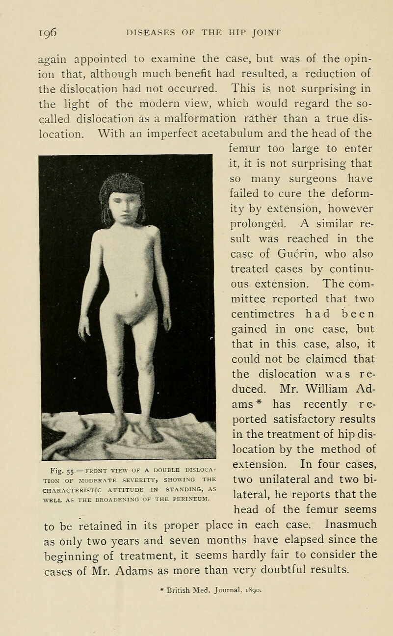 again appointed to examine the case, but was of the opin- ion that, although much benefit had resulted, a reduction of the dislocation had not occurred. This is not surprising in the light of the modern view, which would regard the so- called dislocation as a malformation rather than a true dis- location. With an imperfect acetabulum and the head of the femur too large to enter it, it is not surprising that so many surgeons have failed to cure the deform- ity by extension, however prolonged. A similar re- sult was reached in the case of Guerin, who also treated cases by continu- ous extension. The com- mittee reported that two centimetres had been gained in one case, but that in this case, also, it could not be claimed that the dislocation was re- duced. Mr. William Ad- ams * has recently re- ported satisfactory results in the treatment of hip dis- location by the method of extension. In four cases, two unilateral and two bi- lateral, he reports that the head of the femur seems to be retained in its proper place in each case. Inasmuch as only two years and seven months have elapsed since the beginning of treatment, it seems hardly fair to consider the cases of Mr. Adams as more than very doubtful results. Fig. 55 —FRONT VIE\V OF A DOUBLE Dl-LL A- TION- OF MODERATE SEVERITY, SHOWING THE CHARACTERISTIC ATTITUDE IN STANDING, AS WELL AS THE BROADENING OF THE PERINEUM. * British iMed. Journal, 1890.