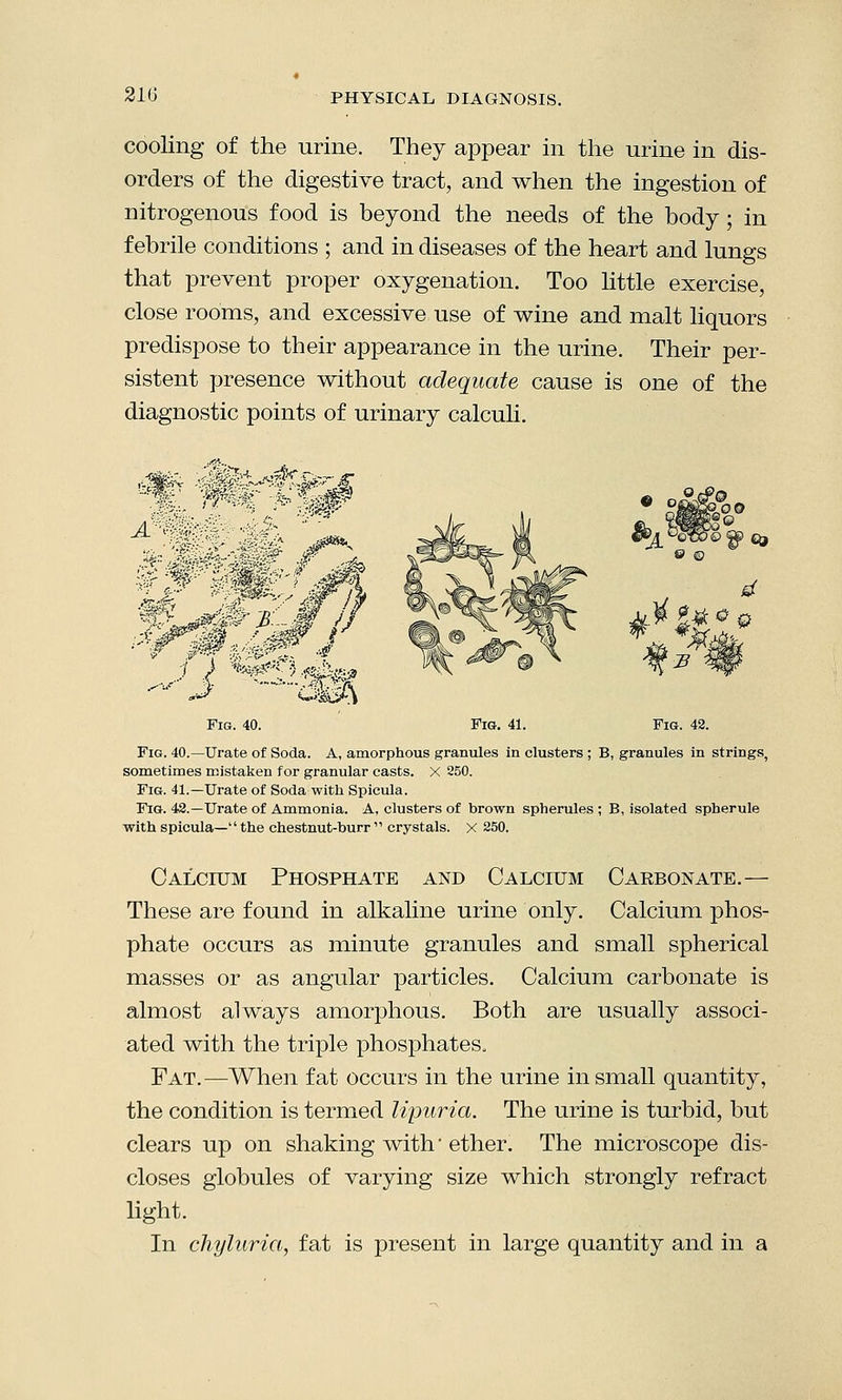 21G cooling of the urine. They appear in the urine in dis- orders of the digestive tract, and when the ingestion of nitrogenous food is beyond the needs of the body; in febrile conditions ; and in diseases of the heart and lungs that prevent proper oxygenation. Too little exercise, close rooms, and excessive use of wine and malt liquors predispose to their appearance in the urine. Their per- sistent presence without adequate cause is one of the diagnostic points of urinary calculi. •B&Cter CM Fig. 40. Fig. 41. Fig. 42. Fig. 40.—Urate of Soda. A, amorphous granules in clusters ; B, granules in strings, sometimes mistaken for granular casts. X 250. Fig. 41.—Urate of Soda with Spicula. Fig. 42.—Urate of Ammonia. A, clusters of brown spherules ; B, isolated spherule with spicula— the chestnut-burr  crystals, x 250. Calcium Phosphate and Calcium Carbonate.— These are found in alkaline urine only. Calcium phos- phate occurs as minute granules and small spherical masses or as angular particles. Calcium carbonate is almost always amorphous. Both are usually associ- ated with the triple phosphates. Fat.—When fat occurs in the urine in small quantity, the condition is termed lipuria. The urine is turbid, but clears up on shaking with' ether. The microscope dis- closes globules of varying size which strongly refract light. In chyluria, fat is present in large quantity and in a
