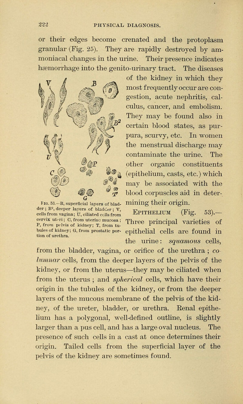 or their edges become crenated and the protoplasm granular (Fig. 25). They are rapidly destroyed by am- moniacal changes in the urine. Their presence indicates haemorrhage into the genito-urinary tract. The diseases of the kidney in which they most frequently occur are con- gestion, acute nephritis, cal- culus, cancer, and embolism. They may be found also in certain blood states, as pur- pura, scurvy, etc. In women the menstrual discharge may contaminate the urine. The other organic constituents ^^ (epithelium, casts, etc.) which may be associated with the blood corpuscles aid in deter- fig. 53.-B, superficial layers of biad- mining their origin. der; B2, deeper layers of bladder; V, -17, m- M\ cells from vagina; U, ciliated cells from -H-PITHELIUM (^ lg. 06).— cervix ut,ri;C, from uterine mucosa; Three principal varieties of P, from pelvis of kidney; T, from tu- r * buies of kidney; g, from prostatic por- epithelial cells are found in tion of urethra. the urine: squamous cells, from the bladder, vagina, or orifice of the urethra ; co- lumnar cells, from the deeper layers of the pelvis of the kidney, or from the uterus—they may be ciliated when from the uterus ; and spherical cells, which have their origin in the tubules of the kidney, or from the deeper layers of the mucous membrane of the pelvis of the kid- ney, of the ureter, bladder, or urethra. Eenal epithe- lium has a polygonal, well-defined outline, is slightly larger than a pus cell, and has a large oval nucleus. The presence of such cells in a cast at once determines their origin. Tailed cells from the superficial layer of the pelvis of the kidney are sometimes found.