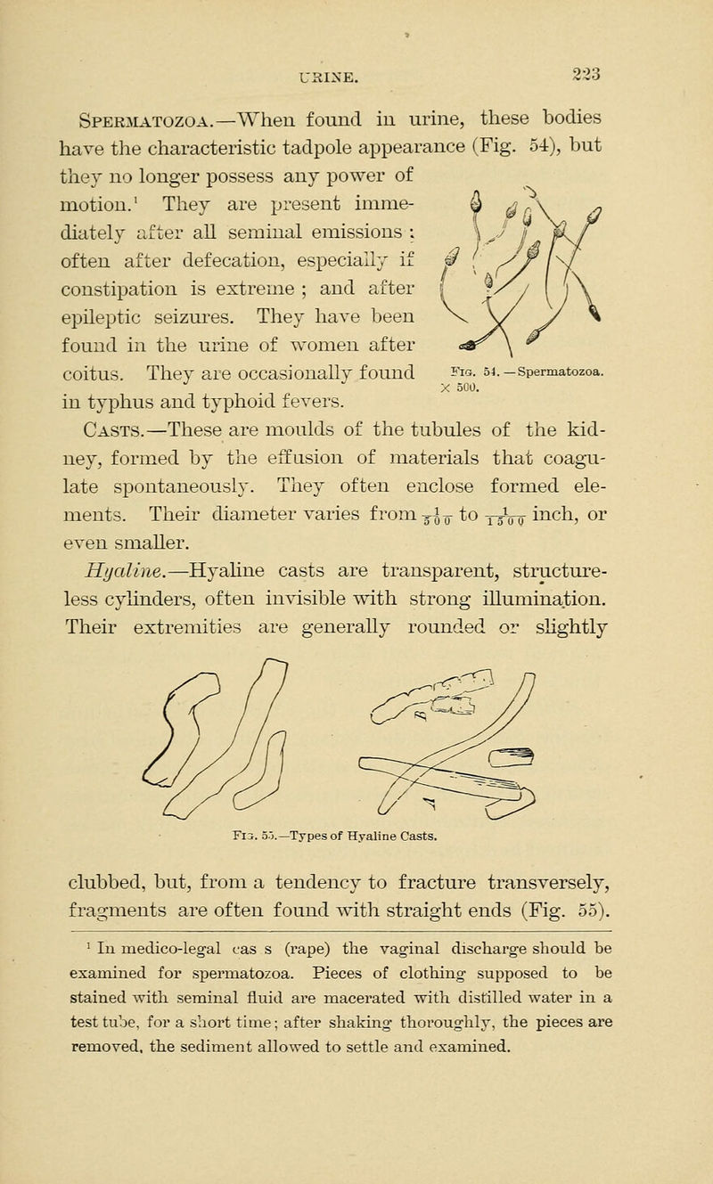 Spermatozoa.— When found in urine, these bodies have the characteristic tadpole appearance (Fig. 54), but thev no longer possess any power of motion.1 They are present imme- diately after all seminal emissions : often after defecation, especially if constipation is extreme ; and after epileptic seizures. They have been found in the urine of women after coitus. They are occasionally found in typhus and typhoid fevers. Casts.—These are moulds of the tubules of the kid- ney, formed by the effusion of materials that coagu- late spontaneously. They often enclose formed ele- ments. Their diameter varies from Tl ¥ to y-Vo inch, or even smaller. Hyaline.—Hyaline casts are transparent, structure- less cylinders, often invisible with strong illumination. Their extremities are generally rounded or slightly Spermatozoa. F13. 5o.—Types of Hyaline Casts. clubbed, but, from a tendency to fracture transversely, fragments are often found with straight ends (Fig. 55). 1 In medicolegal cas s (rape) the vaginal discharge should be examined for spermatozoa. Pieces of clothing supposed to be stained with seminal fluid are macerated with distilled water in a test tube, for a short time; after shaking thoroughly, the pieces are removed, the sediment allowed to settle and examined.