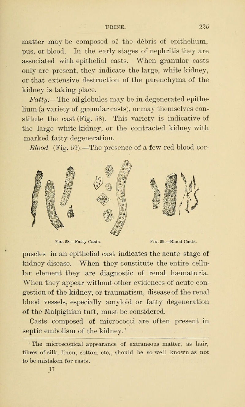 matter may be composed 0* the debris of epithelium, pus, or blood. In the early stages of nephritis they are associated with epithelial casts. When granular casts only are present, they indicate the large, white kidney, or that extensive destruction of the parenchyma of the kidney is taking place. Fatty.—The oil globules may be in degenerated epithe- lium (a variety of granular casts), or may themselves con- stitute the cast (Fig. 58). This variety is indicative of the large white kidney, or the contracted kidney with marked fatty degeneration. Blood (Fig. 59)-—The presence of a few red blood cor- Fig. 58.—Fatty Casts. Fig. 59.—Blood Casts. puscles in an epithelial cast indicates the acute stage of kidney disease. When they constitute the entire cellu- lar element they are diagnostic of renal haematuria. When they appear without other evidences of acute con- gestion of the kidney, or traumatism, disease of the renal blood vessels, especially amyloid or fatty degeneration of the Malpighian tuft, must be considered. Casts composed of micrococci are often present in septic embolism of the kidney.2 1 The microscopical appearance of extraneous matter, as hair, fibres of silk, linen, cotton, etc., should be so well known as not to be mistaken for casts. 17
