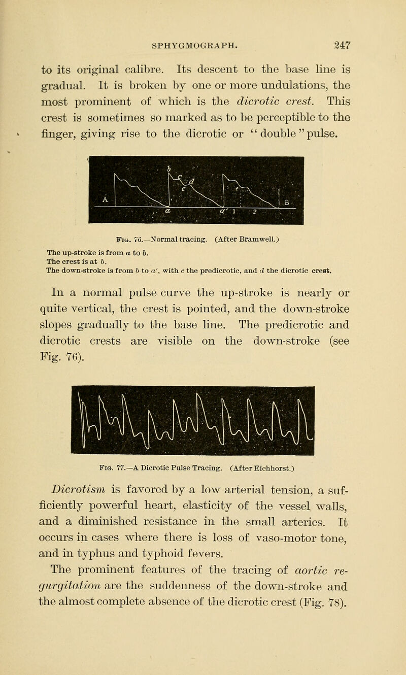 to its original calibre. Its descent to the base line is gradual. It is broken by one or more undulations, the most prominent of which is the dicrotic crest. This crest is sometimes so marked as to be perceptible to the finger, giving rise to the dicrotic or  double  pulse. Fig. 76.—Normal tracing. (After Bramwell.) The up-stroke is from a to b. The crest is at b. The down-stroke is from b to a', with c the predicrotic, and d the dicrotic crest. In a normal pulse curve the up-stroke is nearly or quite vertical, the crest is pointed, and the down-stroke slopes gradually to the base line. The predicrotic and dicrotic crests are visible on the down-stroke (see Fig. 76). Fig. 77.—A Dicrotic Pulse Tracing. (After Eichhorst.) Dicrotism is favored by a low arterial tension, a suf- ficiently powerful heart, elasticity of the vessel walls, and a diminished resistance in the small arteries. It occurs in cases where there is loss of vaso-motor tone, and in typhus and typhoid fevers. The prominent features of the tracing of aortic re- gurgitation are the suddenness of the down-stroke and the almost complete absence of the dicrotic crest (Fig. 78).