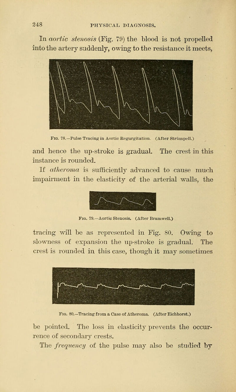In aortic stenosis (Fig. 79) the blood is not propelled into the artery suddenly, owing to the resistance it meets, Fig. 78.—Pulse Tracing in Aortic Regurgitation. (After Striiinpell.) and hence the up-stroke is gradual. The crest in this instance is rounded. If atheroma is sufficiently advanced to cause much impairment in the elasticity of the arterial walls, the Fig. 79.—Aortic Stenosis. (After Bramwell.) tracing will be as represented in Fig. 80. Owing to slowness of expansion the up-stroke is gradual. The crest is rounded in this case, though it may sometimes Fig. 80.—Tracing from a Case of Atheroma. (After Eichhorst.) be pointed. The loss in elasticity prevents the occur- rence of secondary crests. The frequency of the pulse may also be studied by