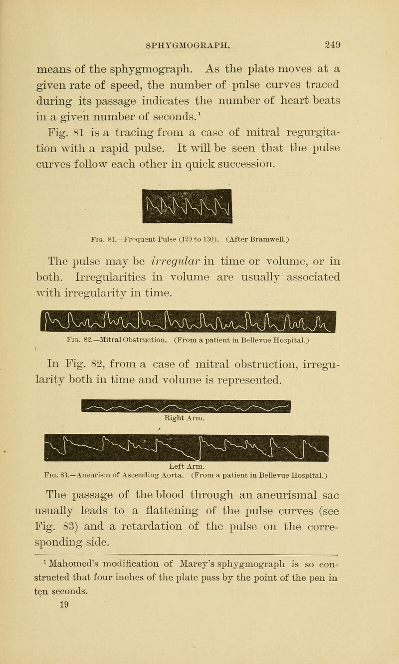 means of the sphygmograph. As the plate moves at a given rate of speed, the number of pulse curves traced duriDg its passage indicates the number of heart beats in a given number of seconds.: Fig. 81 is a tracing from a case of mitral regurgita- tion with a rapid pulse. It will be seen that the pulse curves follow each other in quick succession. Fig. 81.—Fmquant Pulse (12J to 130). (After Bramwell.) The pulse may be irregular in time or volume, or in both. Irregularities in volume are usually associated with irregularity in time. Fig. 82.—Mitral Obstruction. (From a patient in Bellevue Hospital.) i In Fig. 82, from a case of mitral obstruction, irregu- larity both in time and volume is represented. Right Arm. Left Arm. Fig. 83.—Aneurism of Ascending Aorta. (From a patient in Bellevue Hospital.) The passage of the blood through an aneurism al sac usually leads to a flattening of the pulse curves (see Fig. 83) and a retardation of the pulse on the corre- sponding side. 1 Mahomed's modification of Marey's sphygmograph is so con- structed that foui1 inches of the plate pass by the point of the pen in ten seconds. 19