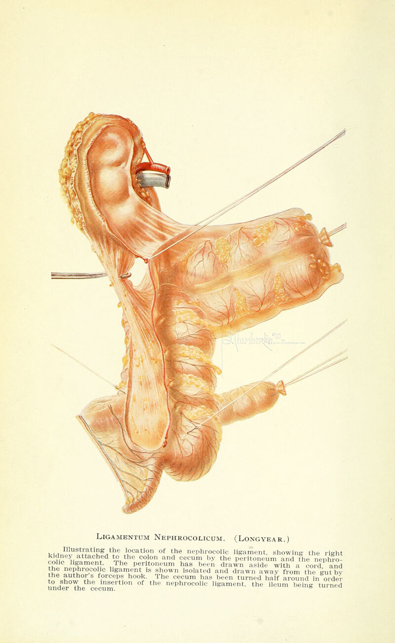 LiGAMENTUM NepHROCOLICUM. (LoNGYEAR.) Illustrating the location of the nephrocolic ligament, showing the right cohc H^ment*^ ^-^h*^ '°-l° ^^ ?,^^ '^^ ^^^ peritoneum and t1.e nepA?o- cohc ligament. The peritoneum has been drawn aside with a cord and the nephrocolic ligament is shown isolated and drawn away from the ^t bv tn^show Thl ^'''''^f- ^°'°^- ./^^^ ^^^^^^ 1^^^ ^^^ turned half around in order unde^The cecum  nephrocolic ligament, the ileum being turned