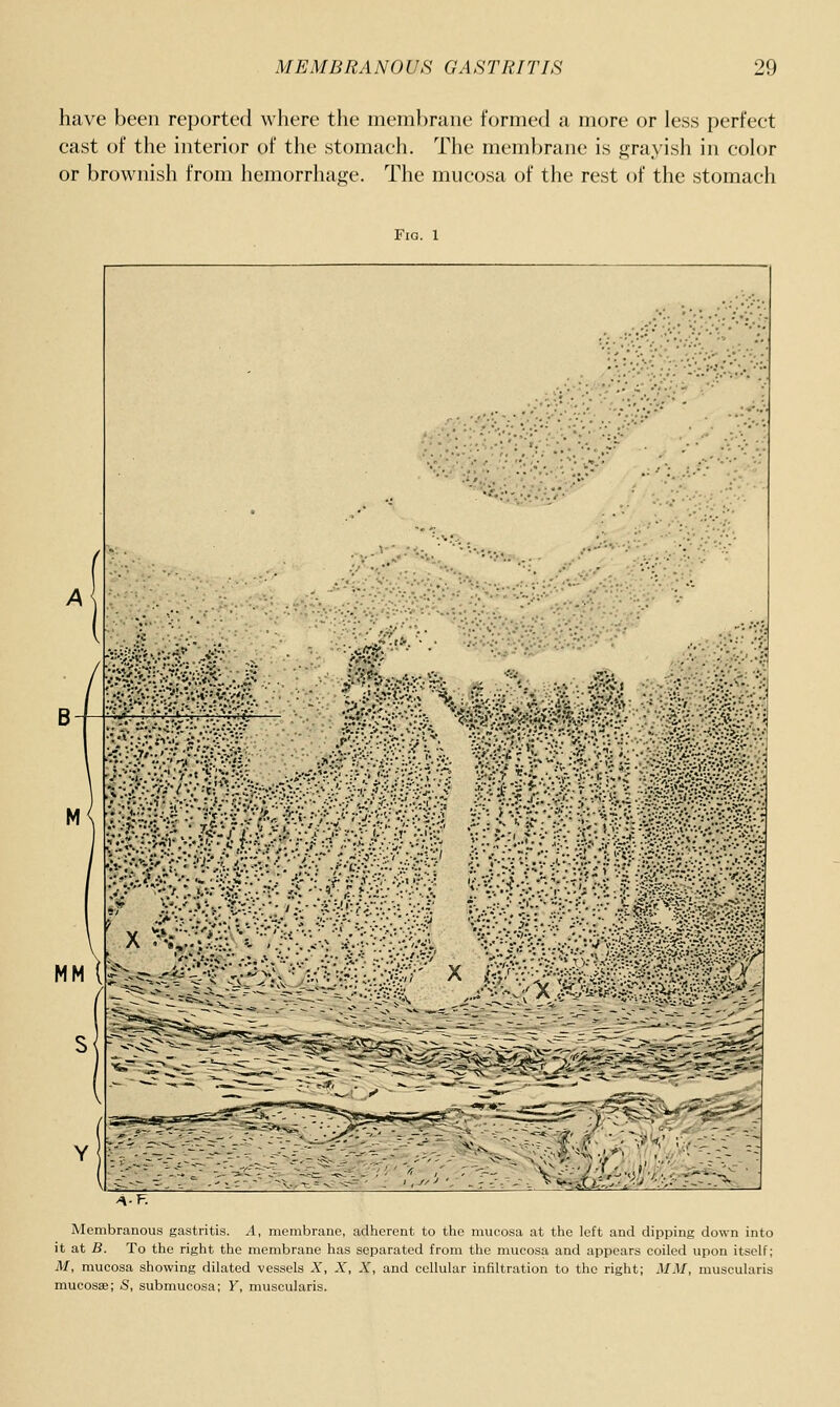 have been reported where the inenibrane formed a more or less perfeet cast of the interior of the stomach. The membrane is grayish in color or brownish from hemorrhage. The mucosa of the rest of the stomach FlQ. 1 M MM ( S ;/■:...•; ■••-V- ^^r' ^f..< '■ '.o'v^. •'. ''.'>'. Membranous gastritis. A, membrane, adherent to the mucosa at the left and dipping down into it at B. To the right the membrane has separated from the mucosa and appears coiled upon itself; M, mucosa showing dilated vessels X, X, X, and cellular infiltration to the right; MM, muscularis mucosae; S, submucosa; Y, muscularis.