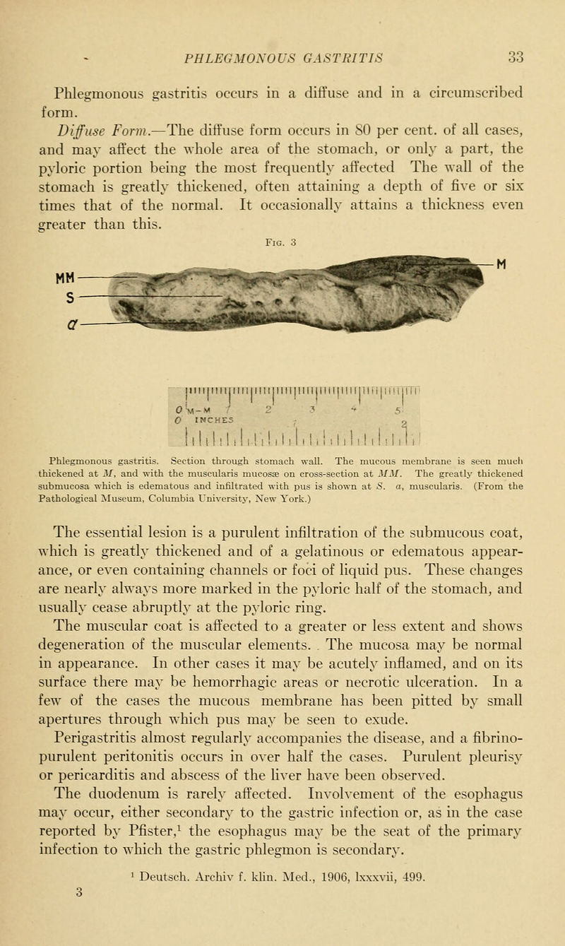 Phlegmonous gastritis occurs in a diffuse and in a circumscribed form. Diffuse Form.—The diffuse form occurs in SO per cent, of all cases, and may affect the whole area of the stomach, or only a part, the pyloric portion being the most frequently affected The wall of the stomach is greatly thickened, often attaining a depth of five or six times that of the normal. It occasionally attains a thickness even greater than this. Fig. 3 |iin|ini|iiii|i!ii|iiii|iiiiiiiiiiiiii{iii{|iiiniir ' |iin|ini|iiii|i!ii|iiii|iiiiii o'm-m / 2 ? - :> 0 INCHES , 2 1111111 i 11! 1! 11111!. i.111!! 11111T)! Phlegmonous gastritis. Section through stomach wall. The mucous membrane is seen much thickened at M, and with the muscularis mucosae on cross-section at MM. The greatly thickened submucosa which is edematous and infiltrated with pus is shown at 5. a, muscularis. (From the Pathological Museuna, Columbia University, New York.) The essential lesion is a purulent infiltration of the submucous coat, which is greatly thickened and of a gelatinous or edematous appear- ance, or even containing channels or foci of liquid pus. These changes are nearly always more marked in the pyloric half of the stomach, and usually cease abruptly at the pyloric ring. The muscular coat is affected to a greater or less extent and shows degeneration of the muscular elements. . The mucosa may be normal in appearance. In other cases it may be acutely inflamed, and on its surface there may be hemorrhagic areas or necrotic ulceration. In a few of the cases the mucous membrane has been pitted by small apertures through which pus may be seen to exude. Perigastritis almost regularly accompanies the disease, and a fibrino- purulent peritonitis occurs in over half the cases. Purulent pleurisy or pericarditis and abscess of the liver have been observed. The duodenum is rarely affected. Involvement of the esophagus may occur, either secondary to the gastric infection or, as in the case reported by Pfister,^ the esophagus may be the seat of the primary infection to which the gastric phlegmon is secondary, ' Deutsch. Archiv f. kliu. Med., 1906, Ixxxvii, 499.