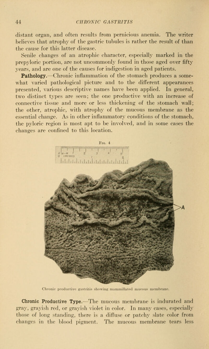 distant organ, and often results from pernicious anemia. The writer believes that atrophy of the gastric tubules is rather the result of than the cause for this latter disease. Senile changes of an atrophic character, especially marked in the prepyloric portion, are not uncommonly found in those aged over fifty years, and are one of the causes for indigestion in aged patients. Pathology.—Chronic inflammation of the stomach produces a some- what varied pathological picture and to the different appearances presented, various descripti\'e names have been applied. In general, two distinct types are seen; the one productive with an increase of connective tissue and more or less thickening of the stomach wall; the other, atrophic, with atrophy of the mucous membrane as the essential change. As in other inflammatory conditions of the stomach, the pyloric region is most apt to be involved, and in some cases the changes are confined to this location. Fig. 4 r nTTf|iiir|iTTT]TrfiTmTjTtiiTfTfi|rnmrnpTirjrrn I ol-M ) 2 3 4' 5! L Jililil.hUiiliJilaUkliUlUiLl Chronic productive gastritis showing miiniinillat'il imirous membrane. Chronic Productive Type.—The mucous membrane is indurated and gray, grayish red, or grayish violet in color. In many cases, especially those of long standing, there is a diffuse or patchy slate color from changes in the blood jjjgmcnt. The mucous membrane tears less