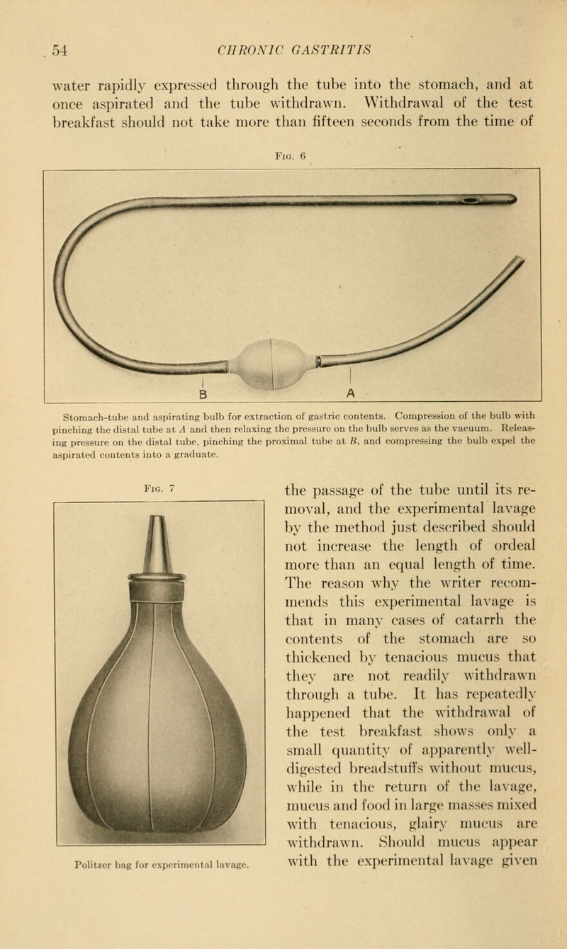 water rapidly expressed through the tube into the stomach, and at once aspirated and the tube withdrawn. Withdrawal of the test breakfast should not take more than fifteen seconds from the time of Stomach-tube and aspirating bulb for extraction of gastric contents. Compression of the bulb with pinching the distal tube at A and then relaxing the pressure on the bulb serves as the vacuum. Releas- ing pressure on the distal tube, pinching the proximal tube at B, and compressing the bulb expel the aspirated contents into a graduate. Fig. Poiitzcr bag for experinicMtul lavage. the passage of the tube until its re- moval, and the ex])erimental lavage by the method just described should not increase the length of ordeal more than an equal length of time. The reason why the writer recom- mends this experimental lavage is that in many cases of catarrh the contents of the stomach are so thickened by tenacious mucus that they are not readily withdrawn through a tube. It has repeatedl\- happened that the withdrawal of the test breakfast shows only a small quantity of apparently well- digested breadstuffs without mucus, while in the return of the lavage, mucus and food in large masses mixed with tenacious, glairy mucus are withdrawn. Should nnicus a])])ear with the exi)erimental lavage given