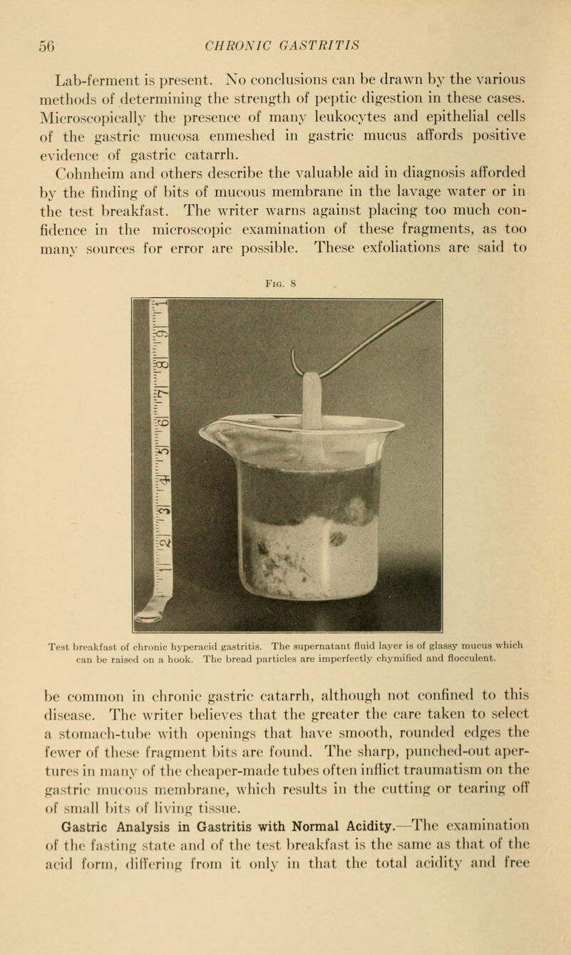 Lab-ferment is present. No conclusions can be drawn by the various methods of determining the strength of peptic digestion in these eases. Microscopically the presence of many leukocytes and epithelial cells of the gastric mucosa enmeshed in gastric mucus affords positive evidence of gastric catarrh. Cohnheim and others describe the valuable aid in diagnosis afforded by the finding of bits of mucous membrane in the lavage water or in the test breakfast. The writer warns against placing too much con- fidence in the microscopic examination of these fragments, as too many sources for error are possible. These exfoliations are said to Fig. 8 Test breakfast of chrDiiic hyperacid gastritis. The supernatant fluid layer is of glassy mucus which can be raised on a hook. The bread particles are imperfectly chymified and flocculent. be common in chronic gastric catarrh, although not confined to this disease. The writer believes that the greater the care taken to select a stomach-tube with openings that have smooth, rounded edges the fewer of these fragment bits are found. The sharp, punched-out aper- tures in many of the cheaper-made tubes often inflict traumatism on the gastric iiukoiis membrane, which results in the cutting or tearing off of small bits of living tissue. Gastric Analysis in Gastritis with Normal Acidity.—The examination of the fasting state and of the test breakfast is the same as that of the acid form, dillering from it only in that the total acidity and free