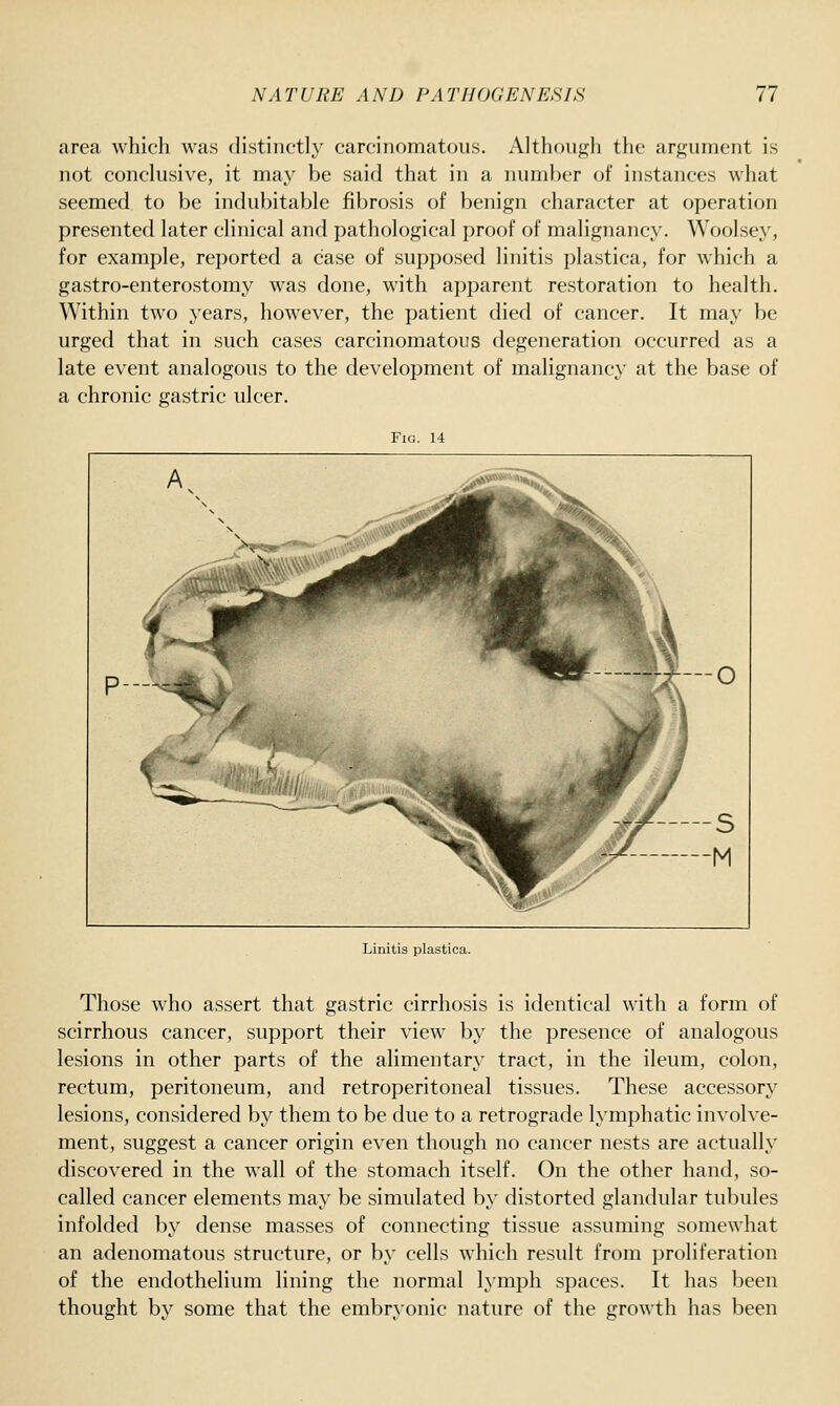 area which was distinctly carcinomatous. Although the argument is not conclusive, it may be said that in a number of instances what seemed to be indubitable fibrosis of benign character at operation presented later clinical and pathological proof of malignancy. Woolsey, for example, reported a case of supposed linitis plastica, for which a gastro-enterostomy was done, with apparent restoration to health. Within two years, however, the patient died of cancer. It may be urged that in such cases carcinomatous degeneration occurred as a late event analogous to the development of malignancy at the base of a chronic gastric ulcer. Fig. 14 Linitis plastica. Those who assert that gastric cirrhosis is identical with a form of scirrhous cancer, support their view by the presence of analogous lesions in other parts of the alimentary tract, in the ileum, colon, rectum, peritoneum, and retroperitoneal tissues. These accessory lesions, considered by them to be due to a retrograde lymphatic involve- ment, suggest a cancer origin even though no cancer nests are actually discovered in the wall of the stomach itself. On the other hand, so- called cancer elements may be simulated by distorted glandular tubules infolded by dense masses of connecting tissue assuming somewhat an adenomatous structure, or by cells which result from proliferation of the endothelium lining the normal lymph spaces. It has been thought by some that the embryonic nature of the growth has been