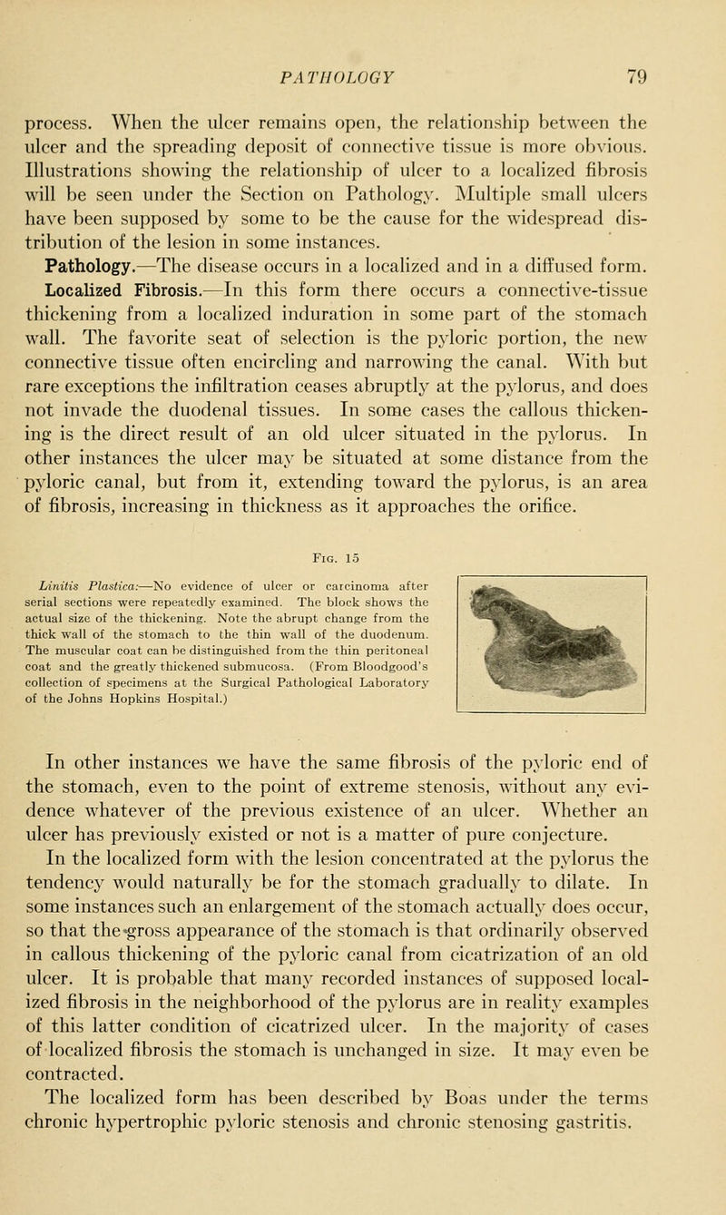 process. When the ulcer remains open, the relationship between the ulcer and the spreading deposit of connective tissue is more obvious. Illustrations showing the relationship of ulcer to a localized fibrosis will be seen under the Section on Pathology. Multiple small ulcers have been supposed by some to be the cause for the widespread dis- tribution of the lesion in some instances. Pathology.—The disease occurs in a localized and in a diffused form. Localized Fibrosis.—In this form there occurs a connective-tissue thickening from a localized induration in some part of the stomach wall. The favorite seat of selection is the pyloric portion, the new connective tissue often encircling and narrowing the canal. With but rare exceptions the infiltration ceases abruptly at the pylorus, and does not invade the duodenal tissues. In some cases the callous thicken- ing is the direct result of an old ulcer situated in the pylorus. In other instances the ulcer may be situated at some distance from the pyloric canal, but from it, extending toward the pylorus, is an area of fibrosis, increasing in thickness as it approaches the orifice. Fig. 15 Linitis Plastica:—No evidence of ulcer or carcinoma after serial sections were repeatedly examined. The block shows the actual size of the thickening. Note the abrupt change from the thick wall of the stomach to the thin wall of the duodenum. The muscular coat can he distinguished from the thin peritoneal coat and the greatly thickened submucosa. (From Bloodgood's collection of specimens at the Surgical Pathological Laboratory of the Johns Hopkins Hospital.) In other instances we have the same fibrosis of the pyloric end of the stomach, even to the point of extreme stenosis, without any evi- dence whatever of the previous existence of an ulcer. Whether an ulcer has previously existed or not is a matter of pure conjecture. In the localized form with the lesion concentrated at the pylorus the tendency would naturally be for the stomach gradually to dilate. In some instances such an enlargement of the stomach actually does occur, so that the'gross appearance of the stomach is that ordinarily observed in callous thickening of the pyloric canal from cicatrization of an old ulcer. It is probable that many recorded instances of supposed local- ized fibrosis in the neighborhood of the pylorus are in reality examples of this latter condition of cicatrized ulcer. In the majority of cases of localized fibrosis the stomach is unchanged in size. It may even be contracted. The localized form has been described by Boas under the terms chronic hypertrophic pyloric stenosis and chronic stenosing gastritis.