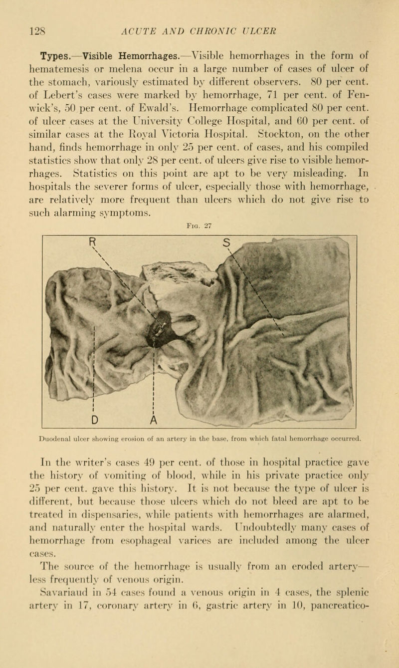 Types.—Visible Hemorrhages.—Visible hemorrhages in the form of hematemesis or meleiia occur in a large number of cases of ulcer of the stomach, variously estimated by difi'erent observers. SO per cent, of Lebert's cases were marked by hemorrhage, 71 per cent, of Fen- wick's, 50 per cent, of Ewald's. Hemorrhage complicated SO per cent, of ulcer cases at the University College Hos])ital, and 00 per cent, of similar cases at the Royal Victoria Hospital. ^Stockton, on the other hand, finds hemorrhage in only 25 per cent, of cases, and his compiled statistics show that only 2S per cent, of ulcers give rise to visible hemor- rhages. Statistics on this point are apt to be very misleading. In hospitals the severer forms of ulcer, especially those with hemorrhage, are relatiAely more frequent than ulcers which do not give rise to such alarming symptoms. Fig. 27 Duodenal ulcer showing erosion of an artery in the base, from wliieh fatal hemorrhage occurred. In the writer's cases 49 per cent, of tliose in hospital i)ractice gave the iiistory of vomiting of blood, while in his })rivate i)ractice only 25 per cent, gave this history. It is not because the type of ulcer is different, !)Ut because those ulcers which do not bleed are aj^t to be treated in disju'iisaries, while i)atients with hemorrhages are alarmed, and naturally enter the h()S])ital wards. rnd()iil)tedly many cases of lu-morrhage from es()|)hag<'al \arices are iiHliidecj among the ulcer cases. The souree of llie lieiiiorrliage is usually from an eroded artery— less frer|iieiilly of xciioiis origin. Savariaud in 54 cases found a venous origin in 4 eases, the sj)leiiic artery in 17, coronary artery in (i, gastric artery in 10, pancreatico-