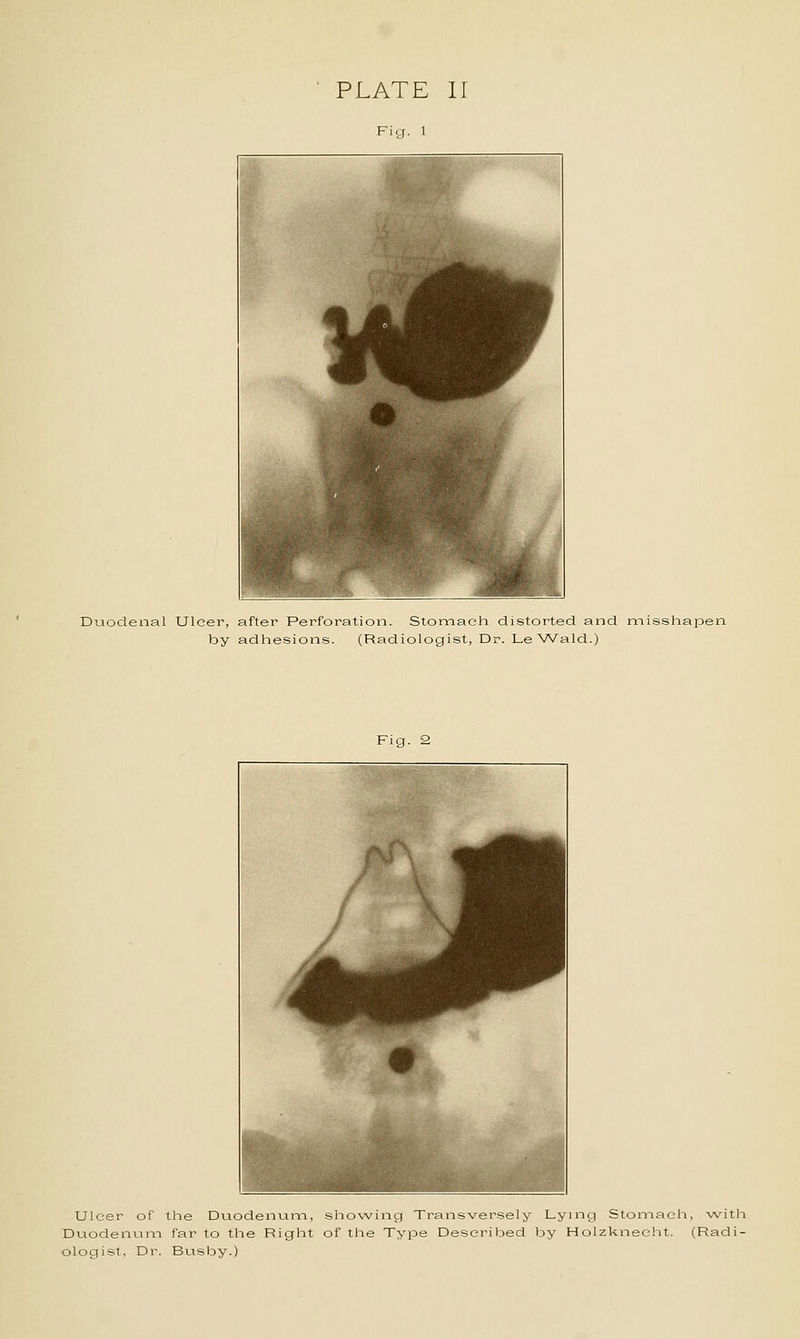 Fig. 1 Duodenal Ulcer, after Perforation. Stomach distorted and misshapen by adhesions. (Radiologist, Dr. Le Wald.) Fig. 2 Ulcer of the Duodenuni, sliowing Transversely Lymg Stomach, with Duodenuni far to the Right of the Type Described by Holzkneelit. (Radi- ologist, Dr. Busby.)