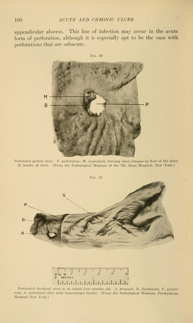 appendicular abscess. This line of infection may occur in the acute form of perforation, althoujjh it is especially apt to be the case with perforations that are subacute. Fig. 30 Perforated gastric ulcer. P. perforation; M, mu.si uLui.^, luiinujg wluu nmains as floor of the ulcer; B, border of ulcer. (From the Pathological Museum of the Mt. Sinai Hospital, New York.) Fig. 31 ItMIIIIIIIIII III I I lltl M jltlllln I 11 M III I II III III • L-M ) 7 .V * 5I INCHES ; J III. I. I. I. I. I. I.I I III I I. I.I. I. I I Perforated duodenal ulcer in an infant four months old. .S, stomach; I), duodenum; P, pyloric ring; A, perforated ulcer with hemorrhagic border. (From the Pathological Museum, Presbyterian Hospital New York.)