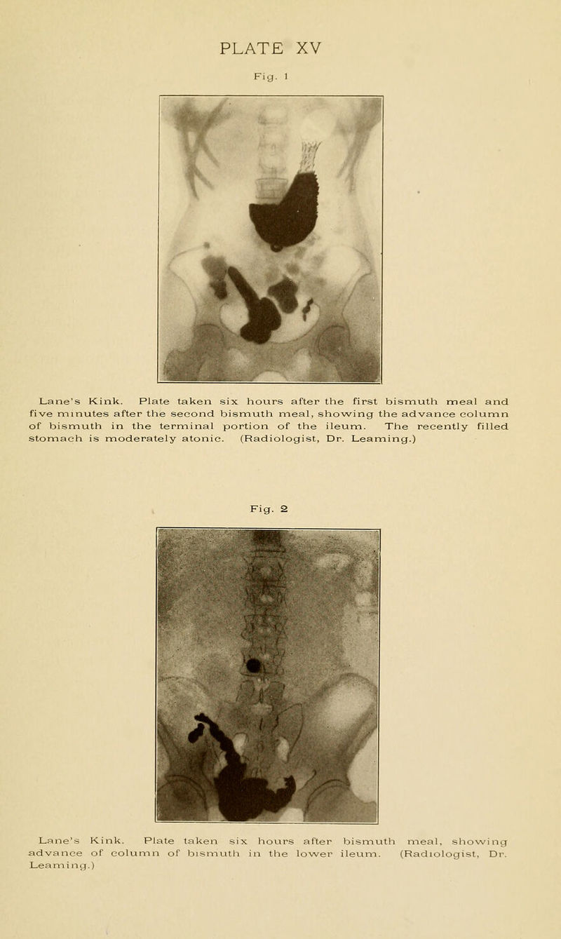 PLATE XV Fi.j, ] Lane's Kink. Plate taken six hours after the first bismutli meal and five nninutes after the second bisnnuth meal, showing the advance column of bismuth in the terminal portion of the ileum. The recently filled stomach is moderately atonic. (Radiologist, Dr. Leaming.) Fig. 2 Lane's Kink. Plate taken six hours after bismuth meal, showing advance of column of bismutli in the lower ileum. (Radiologist, Dr. Leaming.)