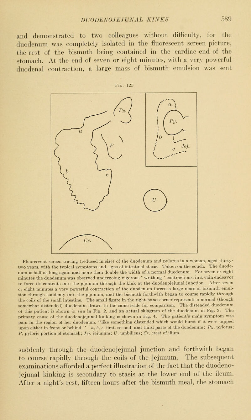 and demonstrated to two colleagues without difficulty, for the duodenum was completely isolated in the fluorescent screen picture, the rest of the bismuth being contained in the cardiac end of the stomach. At the end of seven or eight minutes, with a very powerful duodenal contraction, a large mass of bismuth emulsion was sent Fluorescent screen tracing (reduced in size) of the duodenum and pylorus in a woman, aged thirtj-- two years, with the typical symptoms and signs of intestinal stasis. Taken on the couch. The duode- num is half as long again and more than double the width of a normal duodenum. For seven or eight minutes the duodenum was observed undergoing vigorous writhing contractions, in a vain endeavor to force its contents into the jejunum through the kink at the duodenojejunal junction. After seven or eight minutes a very powerful contraction of the duodenum forced a large mass of bismuth emul- sion through suddenly into the jejunum, and the bismuth forthwith began to course rapidly through the coils of the small intestine. The small figure in the right-hand corner represents a normal (though somewhat distended) duodenum drawn to the same scale for comparison. The distended duodenum of this patient is shown in situ in Fig. 2, and an actual skiagram of the duodenum in Fig. 3. The primary cause of the duodenojejunal kinking is shown in Fig. 4. The patient's main symptom was pain in the region of her duodenum, hke something distended which would burst if it were tapped upon either in front or behind. o, b, c, first, second, and third parts of the duodenum; Py, pylorus; P, pyloric portion of stomach; Jej, jejunum; U, umbilicus; Cr, crest of ilium. suddenly through the duodenojejunal junction and forthwith began to course rapidly through the coils of the jejunum. The subsequent examinations afforded a perfect illustration of the fact that the duodeno- jejunal kinking is secondary to stasis at the lower end of the ileum. After a night's rest, fifteen hours after the bismuth meal, the stomach