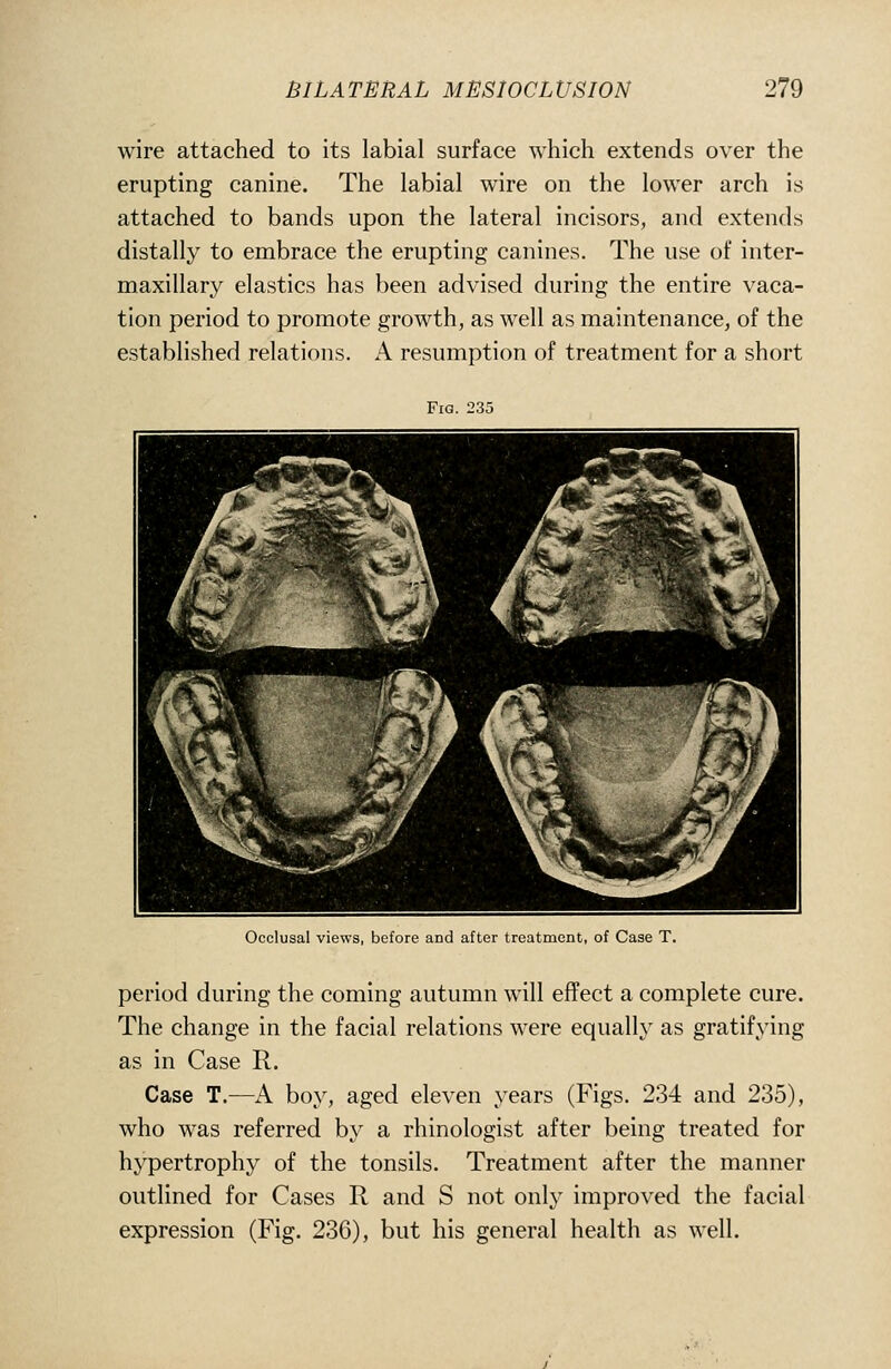 wire attached to its labial surface which extends over the erupting canine. The labial wire on the lower arch is attached to bands upon the lateral incisors, and extends distally to embrace the erupting canines. The use of inter- maxillary elastics has been advised during the entire vaca- tion period to promote growth, as well as maintenance, of the established relations. A resumption of treatment for a short Fig. 235 ■^ 1^9 ^^jj^^^^H ^K^jW ^P 1^ ^ir .^/yJl i^^ ^Sl W^. 4 ■™^;iw£'^ J^kgF^H 1^ ^^ ^ Occlusal views, before and after treatment, of Case T. period during the coming autumn will effect a complete cure. The change in the facial relations were equally as gratifying as in Case R. Case T.—A boy, aged eleven years (Figs. 234 and 235), who was referred by a rhinologist after being treated for hypertrophy of the tonsils. Treatment after the manner outlined for Cases R and S not only improved the facial expression (Fig. 236), but his general health as well.