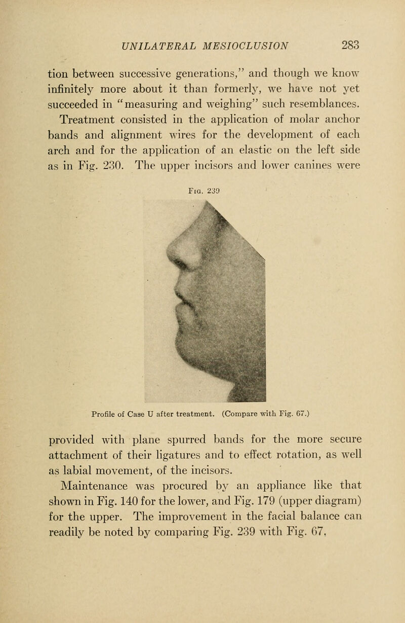 tion between successive generations, and though we know infinitely more about it than formerly, we have not yet succeeded in measuring and weighing such resemblances. Treatment consisted in the application of molar anchor bands and alignment wires for the development of each arch and for the application of an elastic on the left side as in Fig. 230. The upper incisors and lower canines were Fig. 239 Profile of Case U after treatment. (Compare with Fig. 67.) provided with plane spurred bands for the more secure attachment of their ligatures and to effect rotation, as well as labial movement, of the incisors. Maintenance was procured by an appliance like that shown in Fig. 140 for the lower, and Fig. 179 (upper diagram) for the upper. The improvement in the facial balance can readily be noted by comparing Fig. 239 with Fig. 67,