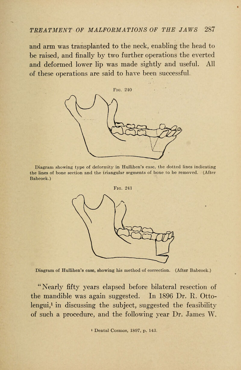 and arm was transplanted to the neck, enabling the head to be raised, and finally by two further operations the everted and deformed lower lip was made sightly and useful. All of these operations are said to have been successful. Fig. 210 Diagram showing type of deformity in HuIIihen'a case, the dotted lines indicating the lines of bone section and the triangular segments of bone to be removed. (After Babcock.) Fig. 241 Diagram of Hullihen's case, showing his method of correction. (After Babcock.) Nearly fifty years elapsed before bilateral resection of the mandible was again suggested. In 1896 Dr. R. Otto- lengui/ in discussing the subject, suggested the feasibility of such a procedure, and the following year Dr. James W.