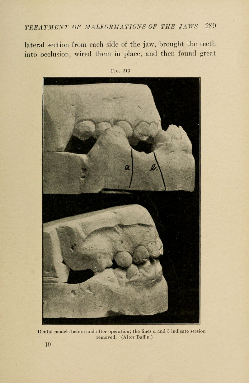 lateral section from each side of the jaw, brought the teetli into occlusion, wired them in place, and then found great Fia. 213 Dental models before and after operation; the lines a and b indicate section removed. (After Ballin ) 19