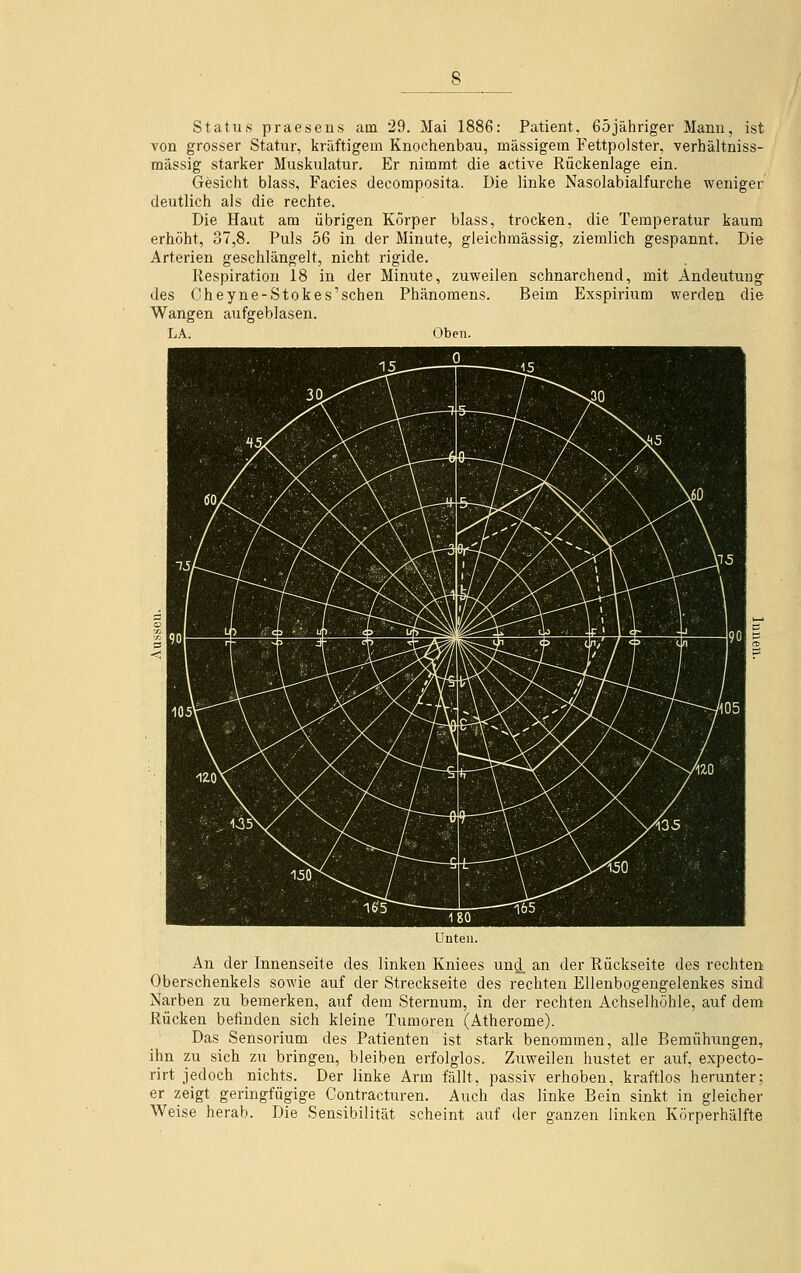 Status praesens am 29. Mai 1886: Patient, 65jähriger Mann, ist von grosser Statur, kräftigem Knochenbau, massigem Fettpolster, verhältniss- massig starker Muskulatur. Er nimmt die active Rückenlage ein. Gesicht blass, Facies decomposita. Die linke Nasolabialfurche weniger deutlich als die rechte. Die Haut am übrigen Körper blass, trocken, die Temperatur kaum erhöht, 37,8. Puls 56 in der Minute, gleichmässig, ziemlich gespannt. Die Arterien geschlängelt, nicht rigide. Respiration 18 in der Minute, zuweilen schnarchend, mit Andeutung des Cheyne-Stok es'sehen Phänomens. Beim Exspirium werden die Wangen aufgeblasen. LA. Oben. Unten. An der Innenseite des. linken Kniees und, an der Rückseite des rechten Oberschenkels sowie auf der Streckseite des rechten Ellenbogengelenkes sind Narben zu bemerken, auf dem Sternum, in der rechten Achselhöhle, auf dem Rücken befinden sich kleine Tumoren (Atherome). Das Sensorium des Patienten ist stark benommen, alle Bemühungen, ihn zu sich zu bringen, bleiben erfolglos. Zuweilen hustet er auf, expecto- rirt jedoch nichts. Der linke Arm fällt, passiv erhoben, kraftlos herunter; er zeigt geringfügige Contracturen. Auch das linke Bein sinkt in gleicher Weise herab. Die Sensibilität scheint auf der ganzen linken Körperhälfte