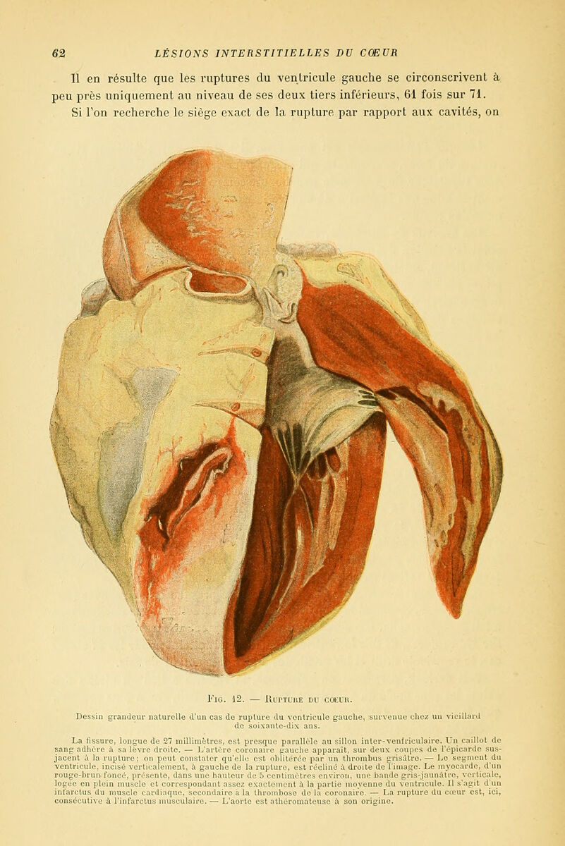 11 en résulte que les ruptures du ventricule gauche se circonscrivent à peu près uniquement au niveau de ses deux tiers inférieurs, 61 fois sur 71. Si l'on recherche le siège exact de la rupture par rapport aux cavités, on I''lG. 12. — lUl'TUUE Dl' COlilK. Dessin grandeur naturelle d'un cas de ruplure du ventricule gauche, de soixante-dix ans. intarclus du niusclo car. oonscjeutive à l'infarctus ne de 27 millimètres, est pres^iue parallèle au siM \ rc droite. — L'artère coronaire ii'auclie appaiail 011 peut constater qu'elle est obîiLér(5o par un 1 1 liiaicment, à gauche de la rupture, est réclinè a rt'-soiile, dans une hauteur de b centimètres cnvirui le et correspondant asse;^ exaotemont à la partie i ■ aqne, secondaire a la thrombose de la coron Ilot de L'aorte est alhéromateuse t\ son i . 1 i.ilV.', !.'■ -■-ment du ,1 ,H,,!_.■. I..' iN>n,,,rdc, d'un unie -I is-jaimaûc. \erticalc, ! du ventricule. Il s'agit d'un ro. — La rupture du cœur est, ici,