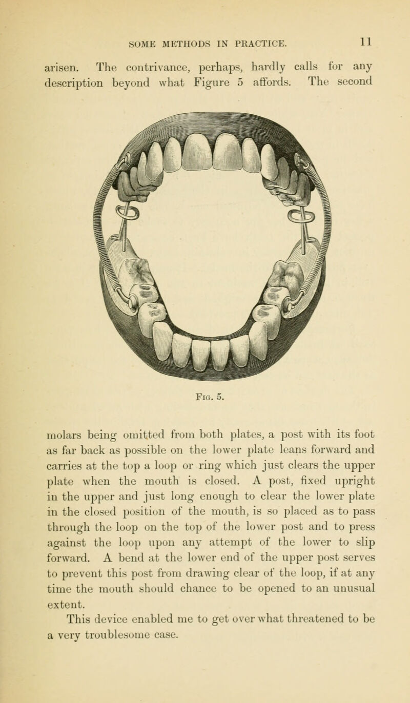 arisen. The contrivance, perhaps, hardly calls for any description beyond what Figure 5 affords. The second Fig. molars being omitted from both plates, a post with its foot as far back as possible on the lower plate leans forward and carries at the top a loop or ring which just clears the upper plate when the mouth is closed. A post, fixed upright in the upper and just long enough to clear the lower plate in the closed position of the mouth, is so placed as to pass through the loop on the top of the lower post and to press against the loop upon any attempt of the lower to slip forward. A bend at the lower end of the upper post serves to prevent this post from drawing clear of the loop, if at any time the mouth should chance to be opened to an unusual extent. This device enabled me to get over what threatened to be a very troublesome case.