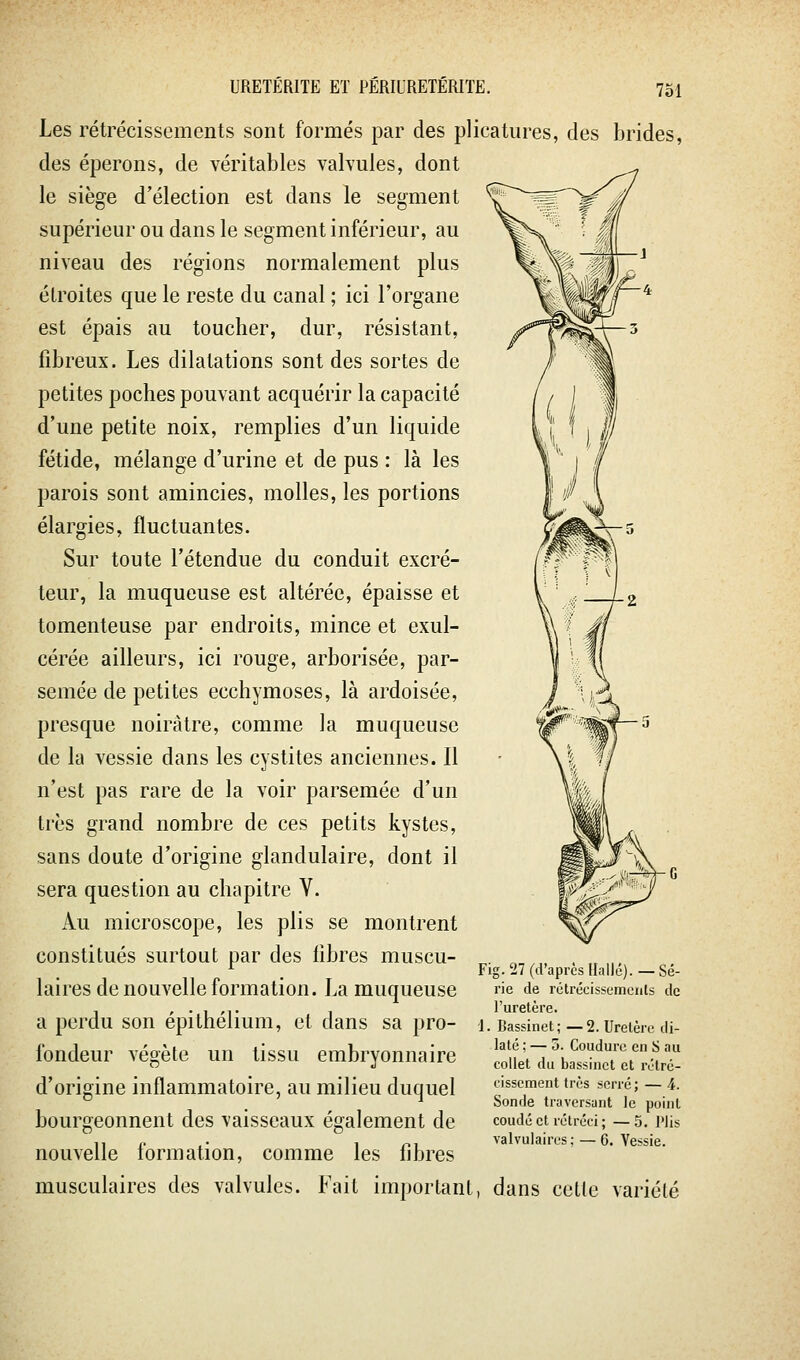 Les rétrécissements sont formés par des plicatures, des brides, des éperons, de véritables valvules, dont le siège d'élection est dans le segment supérieur ou dans le segment inférieur, au niveau des régions normalement plus étroites que le reste du canal ; ici l'organe est épais au toucher, dur, résistant, fibreux. Les dilatations sont des sortes de petites poches pouvant acquérir la capacité d'une petite noix, remplies d'un liquide fétide, mélange d'urine et de pus : là les parois sont amincies, molles, les portions élargies, fluctuantes. Sur toute l'étendue du conduit excré- teur, la muqueuse est altérée, épaisse et tomenteuse par endroits, mince et exul- cérée ailleurs, ici rouge, arborisée, par- semée de petites ecchymoses, là ardoisée, presque noirâtre, comme la muqueuse de la vessie dans les cystites anciennes. Il n'est pas rare de la voir parsemée d'un très grand nombre de ces petits kystes, sans doute d'origine glandulaire, dont il sera question au chapitre V. Au microscope, les plis se montrent constitués surtout par des libres muscu- laires de nouvelle formation. La muqueuse a perdu son épithéliura, et dans sa pro- fondeur végète un tissu embryonnaire d'origine inflammatoire, au milieu duquel bourgeonnent des vaisseaux également de nouvelle formation, comme les fibres musculaires des valvules. Fait important, dans celle variété Fig. 27 (d'après Ilnllé). — Sé- rie de rctrécissumcnts de l'uretère. 1. Bassinet; —2. Uretère di- laté ; — 5. Couduro en S au collet du bassinet et rétré- cissement très serré; — 4. Sonde traversant le point coudé et rétréci ; — 5. Plis valvulaires ; — 6. Vessie.