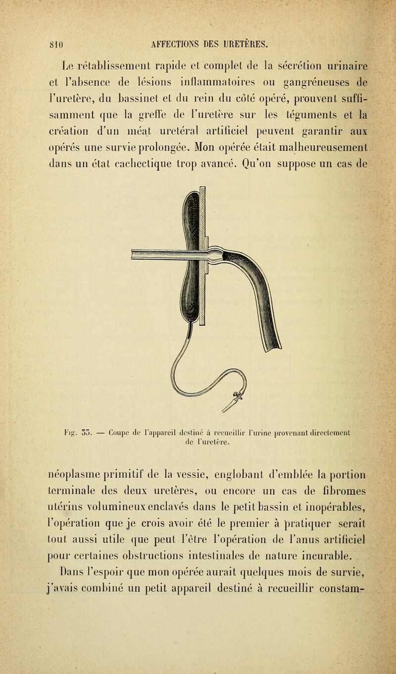 Le rétablissement rapide et complet de la sécrétion urinaire et l'absence de lésions inflammatoires ou gangreneuses de l'uretère, du bassinet et du rein du côlé opéré, prouvent suffi- samment que la greffe de l'uretère sur les téguments et la création d'un méat uretéral artificiel peuvent garantir aux opérés une survie prolongée. Mon opérée était malheureusement dans un état cachectique trop avancé. Qu'on suppose un cas de Fig. 5Ô. — Coupe do l'appareil destiné à recueillir lurinc provenant direclemcnt de l'uretère. néoplasme primitif de la vessie, englobant d'emblée la portion terminale des deux uretères, ou encore un cas de fibromes utérins volumineux enclavés dans le petit bassin et inopérables, l'opération que je crois avoir élé le premier à pratiquer serait tout aussi utile que peut l'être l'opération de l'anus artificiel pour certaines obstructions intestinales de nature incurable. Dans l'espoir que mon opérée aurait quelques mois de survie, j'avais combiné un petit appareil destiné à recueillir constam-