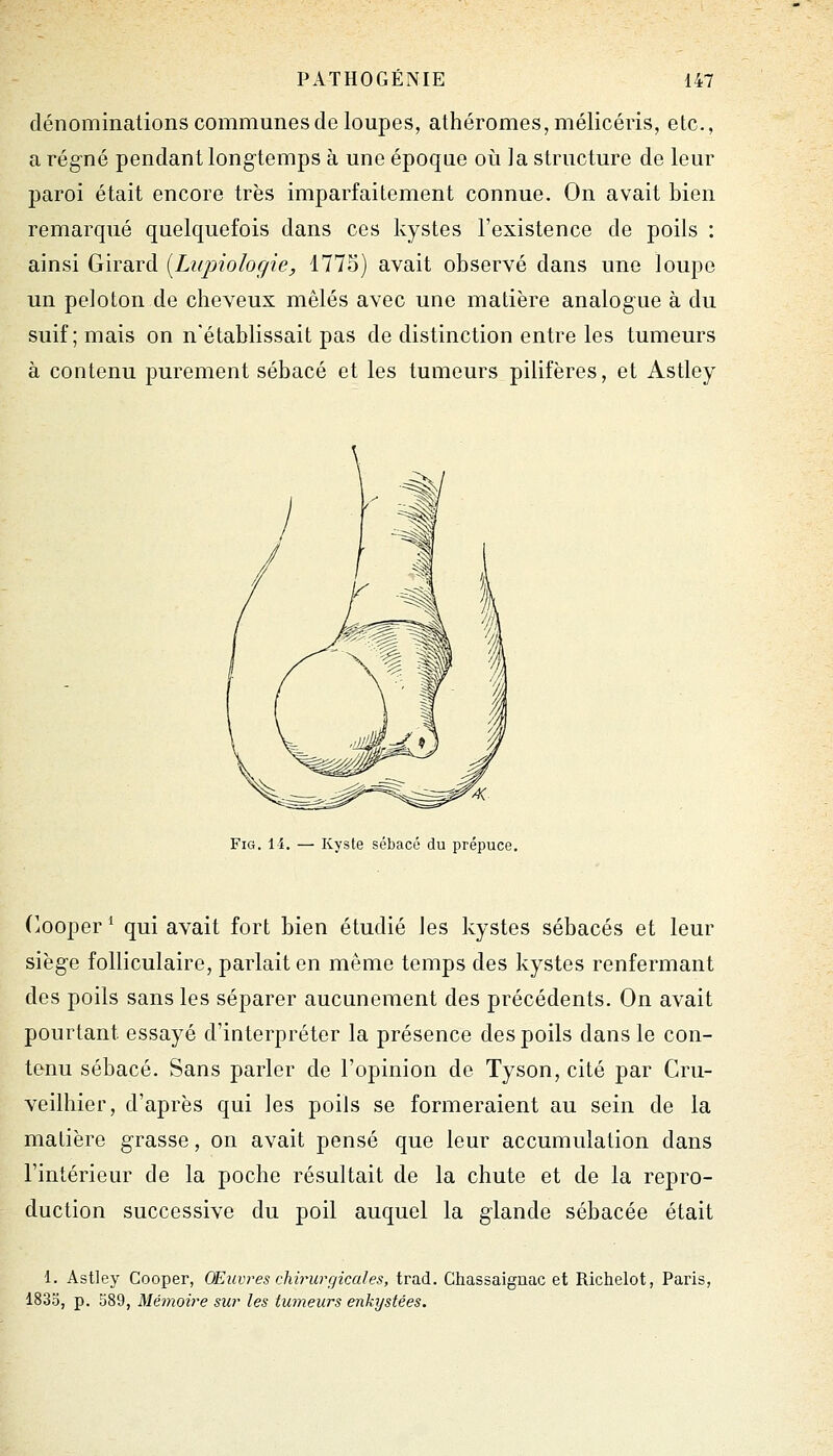 dénominations communes de loupes, athéromes,mélicéris, etc., a régné pendant longtemps à une époque oii la structure de leur paroi était encore très imparfaitement connue. On avait bien remarqué quelquefois dans ces kystes l'existence de poils : ainsi Girard iLupiologie, 177S) avait observé dans une loupe un peloton de cheveux mêlés avec une matière analogue à du suif; mais on n'établissait pas de distinction entre les tumeurs à contenu purement sébacé et les tumeurs pilifères, et Astley FiG. 14. — Kyste sébacé du prépuce. (^ooper^ qui avait fort bien étudié Jes kystes sébacés et leur siège folliculaire, parlait en même temps des kystes renfermant des poils sans les séparer aucunement des précédents. On avait pourtant essayé d'interpréter la présence des poils dans le con- tenu sébacé. Sans parler de l'opinion de Tyson, cité par Cru- yeilhier, d'après qui les poils se formeraient au sein de la matière grasse, on avait pensé que leur accumulation dans l'intérieur de la poche résultait de la chute et de la repro- duction successive du poil auquel la glande sébacée était 1. Astley Cooper, OEuvres chirurgicales, trad. Chassaignac et Richelot, Paris, 1833, p. 389, Mémoire sur les tumeurs enkystées.