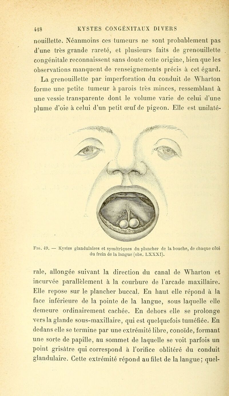 nouillette. Néanmoins ces tumeurs ne sont probablement pas d'une très grande rareté, et plusieurs faits de gTenouillette congénitale reconnaissent sans doute cette origine, bien que les observations manquent de renseignements précis à cet égard. La grenouillette par imperforation du conduit de Wharton forme une petite tumeur à parois très minces, ressemblant à une vessie transparente dont le volume varie de celui d'une plume d'oie à celui d'un petit œuf de pigeon. Elle est unilaté- Fict. 49. — Kystes glandulaires et symétriques du plancher de la bouche, de chaque côté du frein de la langue (obs. LXXXI). raie, allongée suivant la direction du canal de Wharton et incurvée parallèlement à la courbure de l'arcade maxillaire. Elle repose sur le plancher buccal. En haut elle répond à la face inférieure de la pointe de la langue, sous laquelle elle demeure ordinairement cachée. En dehors elle se prolonge vers la glande sous-maxillaire, qui est quelquefois tuméfiée. En dedans elle se termine par une extrémité libre, conoïde, formant une sorte de papille, au sommet de laquelle se voit parfois un point grisâtre qui correspond à l'orifice oblitéré du conduit glandulaire. Cette extrémité répond au filet de la langue; quel-