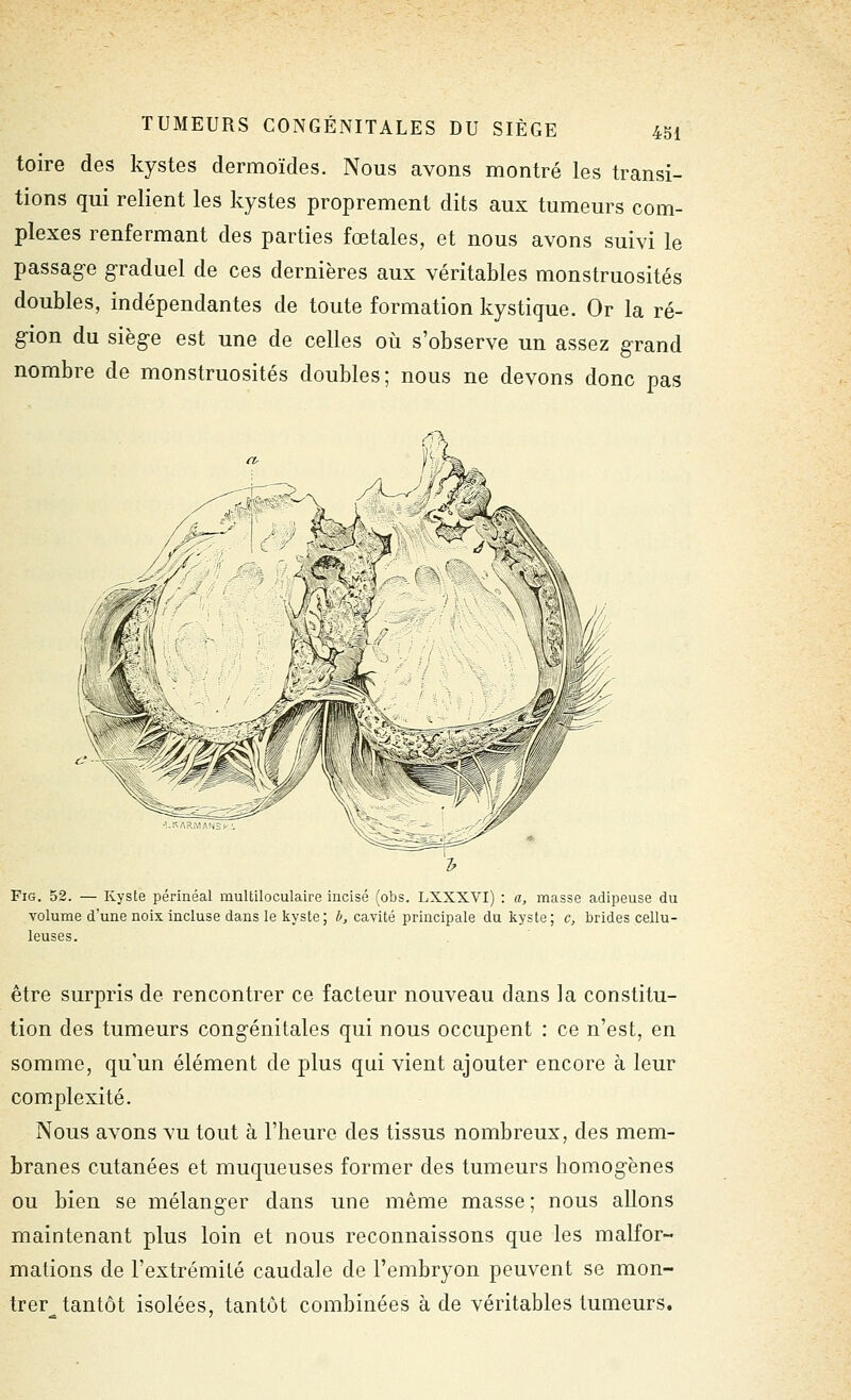 toire des kystes dermoïdes. Nous avons montré les transi- tions qui relient les kystes proprement dits aux tumeurs com- plexes renfermant des parties fœtales, et nous avons suivi le passag-e graduel de ces dernières aux véritables monstruosités doubles, indépendantes de toute formation kystique. Or la ré- gion du siège est une de celles où s'observe un assez grand nombre de monstruosités doubles; nous ne devons donc pas FiG. 52. — Kyste périnéal multiloculaire incisé (obs. LXXXVI) : a, masse adipeuse du volume d'une noix incluse dans le kyste; i», cavité principale du kyste; c, brides cellu- leuses. être surpris de rencontrer ce facteur nouveau dans la constitu- tion des tumeurs congénitales qui nous occupent : ce n'est, en somme, qu'un élément de plus qui vient ajouter encore à leur complexité. Nous avons vu tout à l'heure des tissus nombreux, des mem- branes cutanées et muqueuses former des tumeurs homogènes ou bien se mélanger dans une même masse ; nous allons maintenant plus loin et nous reconnaissons que les malfor- mations de l'extrémité caudale de l'embryon peuvent se mon- trer tantôt isolées, tantôt combinées à de véritables tumeurs.