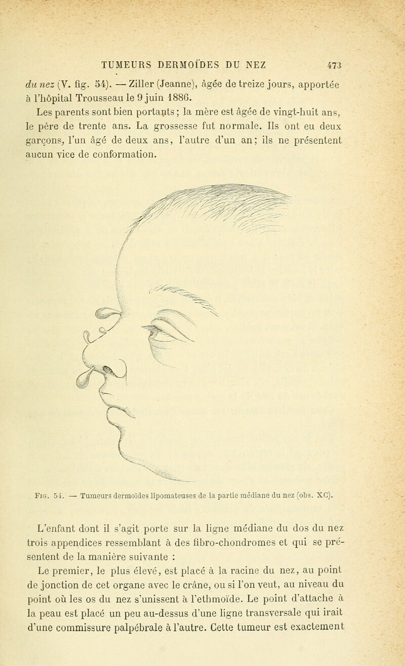 du nez (V. fîg. 54). — Ziller (Jeanne), âgée de treize jours, apportée à l'hôpital Trousseau le 9 juin 1886. Les parents sont bien portants ; la mère est âgée de vingt-huit ans, le père de trente ans. La grossesse fut normale. Ils ont eu deux garçons^ l'un âgé de deux ans, l'autre d'un an ; ils ne présentent aucun vice de conformation. FiG. 54. — Tumeurs dermoïdes lipomateuses de la partie médiane du nez (obs. XC). L'enfant dont il s'agit porte sur la ligne médiane du dos du nez trois appendices ressemblant à des fibro-chondromes et qui se pré- sentent de la manière suivante : Le premier, le plus élevé, est placé à la racine du nez, au point de jonction de cet organe avec le crâne, ou si Ton veut, au niveau du point où les os du nez s'unissent à l'ethmoïde. Le point d'attache à la peau est placé un peu au-dessus d'une ligne transversale qui irait d'une commissure palpébrale à l'autre. Cette tumeur est exactement