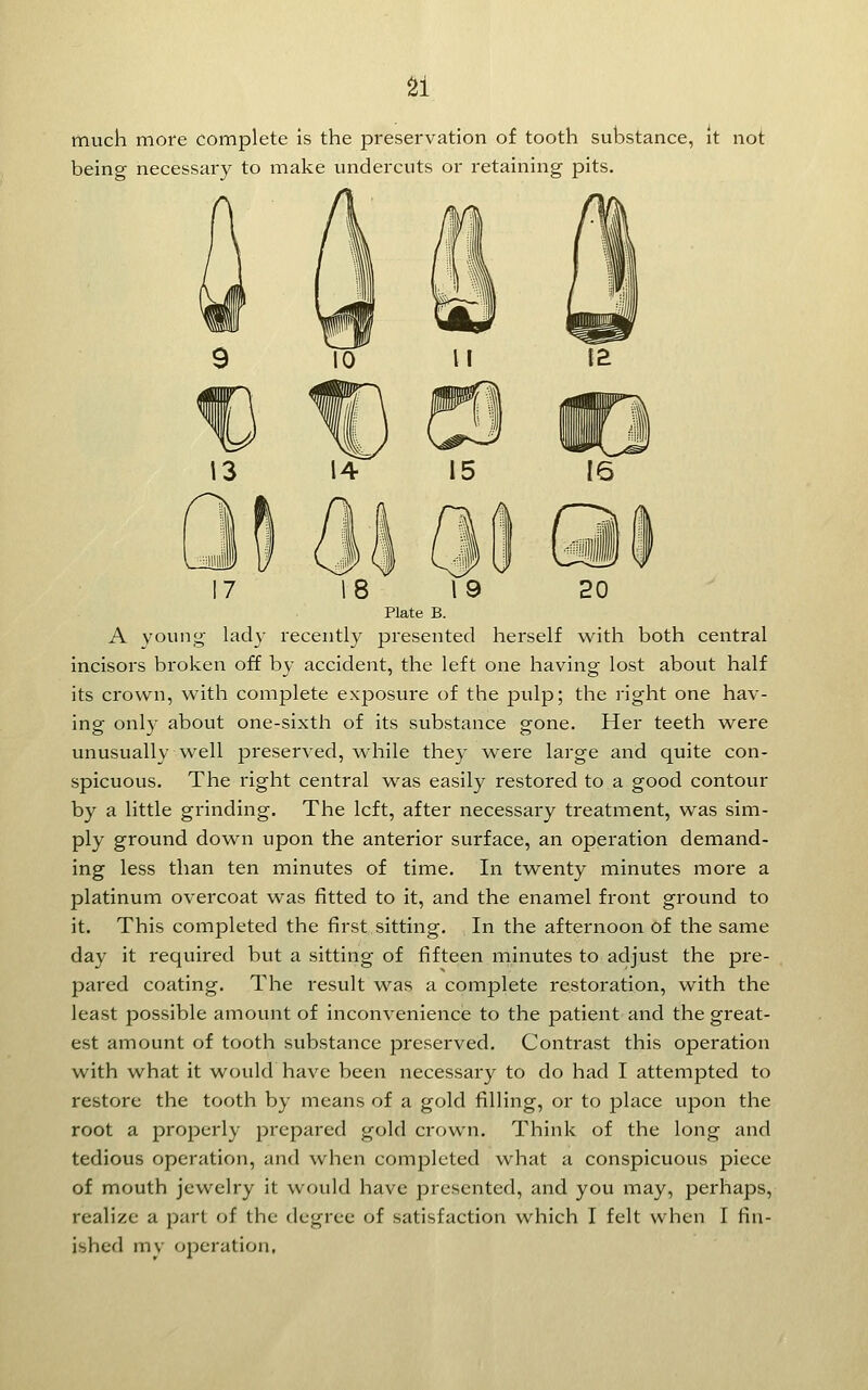 much more complete is the preservation of tooth substance, it not being necessary to make undercuts or retaining pits. 17 18 19 20 Plate B. A young lady recently presented herself with both central incisors broken off by accident, the left one having lost about half its crown, with complete exposui^e of the pulp; the right one hav- ing only about one-sixth of its substance gone. Her teeth were unusually well preserved, while the}- were large and quite con- spicuous. The right central w^as easily restored to a good contour by a little gi-inding. The left, after necessary treatment, was sim- ply ground down upon the anterior surface, an operation demand- ing less than ten minutes of time. In twenty minutes more a platinum overcoat was fitted to it, and the enamel front ground to it. This completed the first sitting. In the afternoon of the same day it required but a sitting of fifteen ininutes to adjust the pre- pared coating. The result was a complete restoration, with the least possible amount of inconvenience to the patient and the great- est amount of tooth substance preserved. Contrast this operation with what it would have been necessary to do had I attempted to restore the tooth by means of a gold filling, or to place upon the root a properly prepared gold crown. Think of the long and tedious operation, and when completed what a conspicuous piece of mouth jewelry it would have presented, and you may, perhaps, realize a part of the degree of satisfaction which I felt when I fin- ished mv operation,