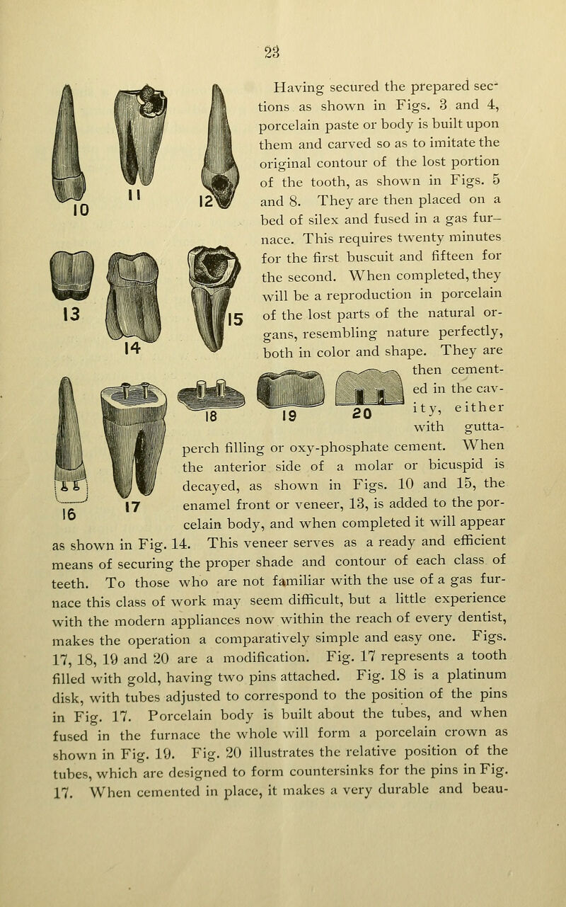 2S Having secured the prepared sec- tions as shown in Figs. 3 and 4, porcelain paste or body is built upon them and carved so as to imitate the original contour of the lost portion of the tooth, as shown in Figs. 5 and 8. They are then placed on a bed of silex and fused in a gas fur- nace. This requires twenty minutes for the first buscuit and fifteen for the second. When completed, they will be a reproduction in porcelain of the lost parts of the natural or- gans, resembling nature perfectly, both in color and shape. They are then cement- ed in the cav- ity, either with gutta- perch tilling or oxy-phosphate cement. When the anterior side of a molar or bicuspid is decayed, as shown in Figs. 10 and 15, the enamel front or veneer, 13, is added to the por- celain body, and when completed it will appear as shown in Fig. 14. This veneer serves as a ready and efficient means of securing the proper shade and contour of each class of teeth. To those who are not familiar with the use of a gas fur- nace this class of work may seem difficult, but a little experience with the modern appliances now within the reach of every dentist, makes the operation a comparatively simple and easy one. Figs. 17, 18, 19 and 20 are a modification. Fig. 17 represents a tooth filled with gold, having two pins attached. Fig. 18 is a platinum disk, with tubes adjusted to correspond to the position of the pins in Fig. 17. Porcelain body is built about the tubes, and when fused in the furnace the whole will form a porcelain crown as shown in Fig. 19. Fig. 20 illustrates the relative position of the tubes, which are designed to form countersinks for the pins in Fig. 17. When cemented in place, it makes a very durable and beau-