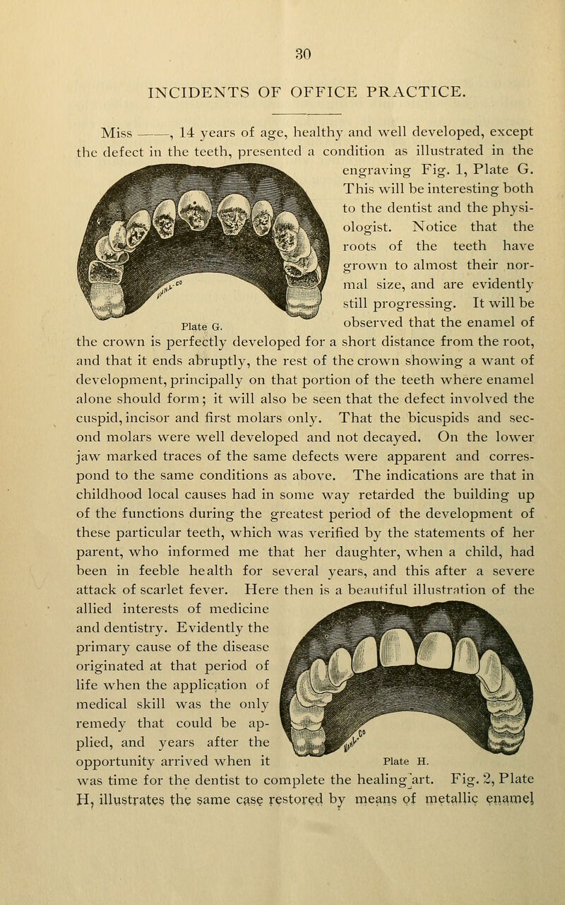 INCIDENTS OF OFFICE PRACTICE. Miss , 14 years of age, healthy and well developed, except the defect in the teeth, presented a condition as illustrated in the engraving Fig. 1, Plate G. This will be interesting both to the dentist and the physi- ologist. Notice that the roots of the teeth have grown to almost their nor- mal size, and are evidently still progressing. It w^ill be Plate G. observed that the enamel of the crown is perfectly developed for a short distance from the root, and that it ends abruptly, the rest of the crown showing a want of development, principally on that portion of the teeth where enamel alone should form; it will also be seen that the defect involved the cuspid, incisor and first molars only. That the bicuspids and sec- ond molars were ^vell developed and not decayed. On the lower jaw marked traces of the same defects were apparent and corres- pond to the same conditions as above. The indications are that in childhood local causes had in some way retarded the building up of the functions during the greatest period of the development of these particular teeth, which was verified by the statements of her parent, who informed me that her daughter, when a child, had been in feeble health for several years, and this after a severe attack of scarlet fever. Here then is a beautiful illustration of the allied interests of medicine and dentistry. Evidently the primary cause of the disease originated at that period of life when the application of medical skill was the only remedy that could be ap- plied, and years after the opportunity arrived when it Plate H. was time for the dentist to complete the healing]art. Fig. 2, Plate H, illwstrjvtes the same case restored by means of metallic enamel