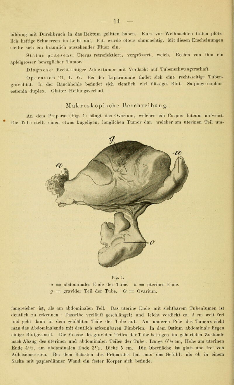 bildung mit Durchbruch in das Rektum gelitten haben. Kurz vor Weihnachten traten plötz- lieli heftige Schmerzen im Leibe auf. Pat. wurde öfters ohnmächtig. Mit diesen Erscheinungen stellte sich ein bräunlich aussehender Fluor ein. Status praesens: Uterus retrofielitiert, vergrössert, weich. Rechts von ihm ein apfelgrosser beweglicher Tumor. Diagnose: Rechtsseitiger Adnextumor mit Verdacht auf Tubenschwangerschaft. Operation 21. I. 97. Bei der Laparotomie findet sich eine rechtsseitige Tuben- gravidität. In der Bauchhöhle befindet sich ziemlich viel flüssiges Blut. Salpingo-oophor- ectomia duplex. Glatter Heilungsverlauf. Makroskopische Beschreibung. An dem Präparat (Fig. 1) hängt das Ovarium, welches ein Corpus luteum aufweist. Die Tube stellt einen etwas kugeligen, länglichen Tumor dar, welcher am uterinen Teil um- Fig. 1. a = abdominales Ende der Tube, u ■= uterines Ende. g = gravider Teil der Tube. 0 = Ovarium. fangreicher ist, als am abdominalen Teil. Das uterine Ende mit sichtbarem Tubenlumen ist deutlich zu erkennen. Dasselbe verläuft geschlängelt und leicht verdickt ca. 2 cm weit frei und geht dann in dem geblähten Teile der Tube auf. Am anderen Pole des Tumors sieht man das Abdominalende mit deutlich erkennbaren Fimbj'ien. In dem Ostium abdominale liegen einige Blutgerinsel. Die Maasse des graviden Teiles der Tube betragen im gehärteten Zustande nach Abzug des uterinen und abdominalen Teiles der Tube: Länge 6^/2 cm, Höhe am uterinen Ende 4^/2, am abdominalen Ende 3V2, Dicke 5 cm. Die Oberfläche ist glatt und frei von Adhäsionsresten. Bei dem Betasten des Präparates hat man das Gefühl, als ob in einem Sacke mit papierdünner Wand ein fester Körjjer sieh befinde.