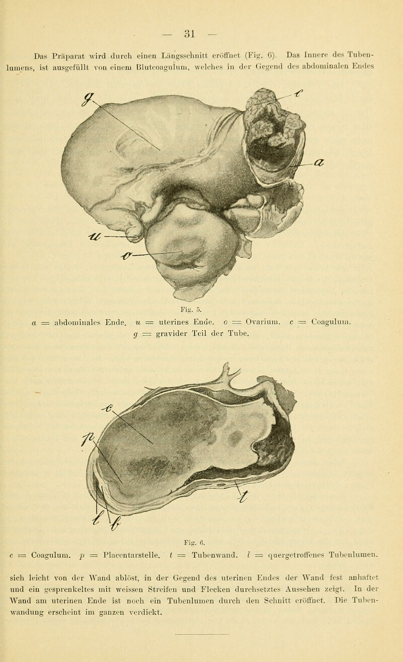 Das Prüpanit wird durch einen LiiiiKSseimitt err.ffnet (Fiir. G). Das IniiiTe des Tnheii- luinciis, ist ausgefüllt von einem Hluteoagnlum, welrhcs in der Gegend dos abdoniiiiaieii Endes Fig. 5. = abdominales Ende, u ^= uterines Ende, o = Ovaiium. c = Coaguluiu. g = gravidei- Teil der Tube. Fig. 6. c = Coaguluiu. p = Placcntarstelle. t = Tubenwaud. l = quergetroflenes Tubenlumen. sich leicht von der Wand ablöst, in der Gegend des uterinen Endes der Wand fest anhaftet und ein gesprenkeltes mit weissen Streifen und Flecken durchsetztes Aussehen zeigt. la der Wand am uterinen Ende ist noch ein Tubenlumen durch den Schnitt erölVnct. Die Tuben- wanduug erscheint im ganzen verdickt.
