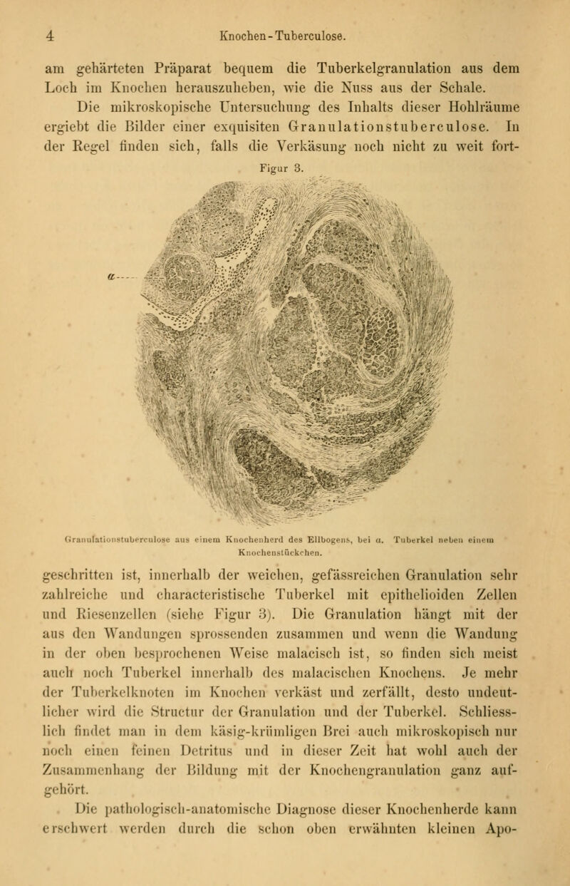 am gehärteten Präparat bequem die Tuberkelgranulation aus dem Loch im Knochen herauszuheben, wie die Nuss aus der Schale. Die mikroskopische Untersuchung des Inhalts dieser Hohlräume ergiebt die Bilder einer exquisiten Grauulationstuberculose. In der Regel finden sich, falls die Verkäsung noch nicht zu weit fort- Figur 3. V M -it.. (iranulatiijiistuberciilose aus einem Knochenherd des Ellbogens, bei a. Tuberkel neben einem Knochens tückohen. gesehritten ist, innerhalb der weichen, gefässreichen Granulation sehr zahlreiche und charactcristische Tuberkel mit epithelioiden Zellen und Riesenzeilen (siehe Figur 3). Die Granulation hängt mit der aus den Wandungen sprossenden zusammen und wenn die Wandung in der oben ]}esi)rochenen AVcise malacisch ist, so finden sich meist auch noch Tuberkel innerhalb des malacischcn Knochens. Je mehr der Tuberkelknoten im Knochen verkäst und zerfällt, desto undeut- licher wird die Structur der Granulation und der Tuberkel. Schliess- lich findet man in dem käsig-krümligen Brei auch mikroskopisch nur noch einen feinen Detritus und in dieser Zeit hat wohl auch der Zusammenhang der Bildung mit der Knochengranulation ganz auf- gehört. Die pathologisch-anatomische Diagnose dieser Knochenherde kann erschwert werden durch die schon oben erwähnten kleineu Apo-