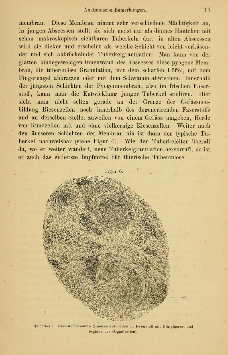 merabran. Diese Membran nimmt sehr verschiedene Mächtigkeit an, in jungen Abscessen stellt sie sich meist nur als dünnes Häutchen mit schon makroskopisch sichtbaren Tuberkeln dar, in alten Abscessen wird sie dicker und erscheint als weiche Schicht von leicht verkäsen- der und sich abbröckelnder Tuberkelgranulation. Man kann von der glatten bindegewebigen Innenwand des Abscesses diese pyogene Mem- bran, die tubereulöse Granulation, mit dem scharfen Löffel, mit dem Fingernagel abkratzen oder mit dem Schwamm abwischen. Innerhalb der jüngsten Schichten der Pyogenmembran, also im frischen Faser- stoff, kann man die Entwicklung junger Tuberkel studiren. Hier sieht man nicht selten gerade an der Grenze der Gefässneu- bildung Riesenzellen noch innerhalb des degenerirenden Faserstoffs und an derselben Stelle, zuweilen von einem Gefäss umgeben, Herde von Rundzellen mit und ohne vielkernige Riesenzellen. Weiter nach den äusseren Schichten der Membran hin ist dann der typische Tu- berkel nachweisbar (siehe Figur 6). Wie der Tuberkeleiter überall da, wo er weiter wandert, neue Tuberkelgranulation hervorruft, so ist er auch das sicherste Impfmittel für thierische Tubereulöse. Figur 6. ■j^' Tuberkel in Faserstoffmembran (Rundzellentiiberkel in Faserstoff mit Blntpigment und beginnender Organisation).