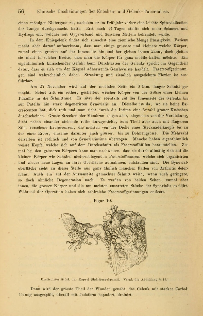 einen massigen Bluterguss zu, nachdem er im Frühjahr vorher eine leichte Spitzenaffection der Lunge durchgemacht hatte. Erst nach 14 Tagen stellte sich mehr Sclimerz und Hydrops ein, welcher mit Gypsverband und äusseren Mitteln behandelt wurde. In dem Kniegelenk findet sich zunächst eine ziemliche Menge Flüssigkeit. Patient macht aber darauf aufmerksam, dass man einige grössere und kleinere weiche Körper, zumal einen grossen auf der Innenseite hin und her gleiten lassen tann, doch gleiten sie nicht in solcher Breite, dass man die Körper für ganz mobile halten möchte. Ein eigenthümlich knirschendes Gefühl beim Durchtasten des Gelenks spricht im Gegentheil dafür, dass es sich um der Kapsel adhärirende Geschwülste handelt. Faserstoffgerinnun- gen sind wahrscheinlich dabei. Streckung und ziemlich ausgedehnte Flexion ist aus- führbar. Am 27. November wird auf der medialen Seite ein 8 Ctm. langer Schnitt ge- macht. Sofort tritt ein rother, gestielter, weicher Körper von der Grosse einer kleinen Pflaume in die Schnittlinie. Er sitzt der ebenfalls auf der Innenseite des Gelenks bis zur Patella hin stark degenerirten Synovialis an. Dieselbe ist da, wo sie keine Ex- crescenzen hat, dick roth und man sieht durch die Intima eine Anzahl grauer Knötchen durchscheinen. Grosse Strecken der Membran zeigen aber, abgesehen von der Verdickung, dicht neben einander stehende rothe kurzgestielte, zum Theil aber auch mit längerem Stiel versehene Excrescenzen, die meisten von der Dicke eines Stecknadelknopfs bis zu der einer Erbse, einzelne darunter auch grösser, bis zu Bohnengrösse. Die Mehrzahl derselben ist röthlich und von Synovialintima überzogen. Manche haben eigenthümlich weisse Köpfe, welche sich auf dem Durchschnitt als Faserstoffhüllen herausstellen. Zu- mal bei den grösseren Körpern kann man nachweisen, dass sie durch allmälig sich auf die kleinen Körper wie Schalen niederschlagenden Faserstoffmassen, welche sich organisirten und wieder neue Lagen an ihrer Oberfläche aufnahmen, entstanden sind. Die Synovial- oberfläche sieht an dieser Stelle aus ganz ähnlich manchen Fällen von Arthritis defor- mans. Auch ein auf der Aussenseite gemachter Schnitt weist, wenn auch geringere, so doch ähnliche Degeneration nach. Es werden von beiden Seiten, zumal aber innen, die grossen Körper und die am meisten entarteten Stücke der Synovialis excidirt. Während der Operation haben sich zahlreiche Faserstoffgerinnungen entleert. Figur 10. ExslirpirtPS Stiick der Kapsel (Sjiiritnspnip.Trat). Vcr^l. die Abliildiing §. !.■>. Dann wird der grösste Theil der Wunden genäht, das Gelenk mit starker Carbol- lös ung ausgespült, überall mit Jodoform bepudert, drainirt.