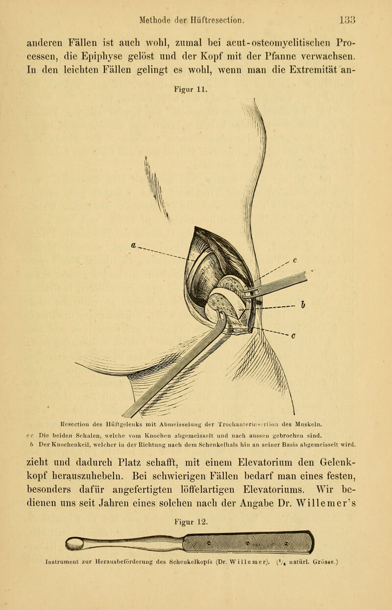 anderen Fällen ist auch wohl, zumal bei acut-osteomyelitischen Pro- cessen, die Epiphyse gelöst und der Kopf mit der Pfanne verwachsen. In den leichten Fällen gelingt es wohl, wenn man die Extremität an- Figur 11. Kesectioii des Hül'lgelenks mit Abiueissehini^ der TrücUaiileriiis; rli(j:i des Muskeln. cc Die beiden Schalen, welche vom Knochen abgemeisselt und nach aussen gebrochen sind. h Der Knochenkeil, welcher in der Richtung nach dem Schenkelhals hin an seiner Basis abgeracisselt wird. zieht und dadurch Platz schafft, mit einem Elevatorium den Gelenk- kopf herauszuhebein. Bei schwierigen Fällen bedarf man eines festen, besonders dafür angefertigten löftelartigen Elevatoriums. Wir be- dienen uns seit Jahren eines solchen nach der Angabe Dr. Willemer's Figur 12. Instrument zur Heraushel'örderung des Schenkelkoprs (Dr. Willem er). {^,\ natürl. Grc'isse.)