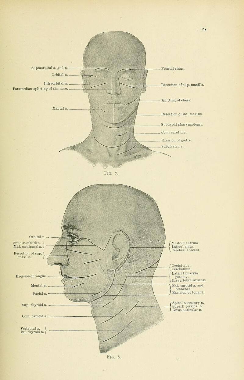 Supraorbital a. and n. Orbital n. Infraorbital n. Paramedian splitting of the nose. Frontal sinus. Resection of sup. maxilla. Splitting of cheek. Resection of inf. maxilla. Subhyoid pharyngotomy. Com. carotid a. Excision of goitre. _ Subclavian a. Fig. 7. Resection of sup. 1 Vertebral a. 1 Inf. thyroid a. J i Mastoid antrum. Lateral sinus. Cerebral abscess. /Occipital a. \ Cerebellum. f Lateral pharyn- \ gotomy. VPrevertebral abscess. Ext. carotid a. and branches. Excision of tongue. C Spinal-accessory n. — ) Superf. cervical n. 1^ Great auricular n. Fig. 8.